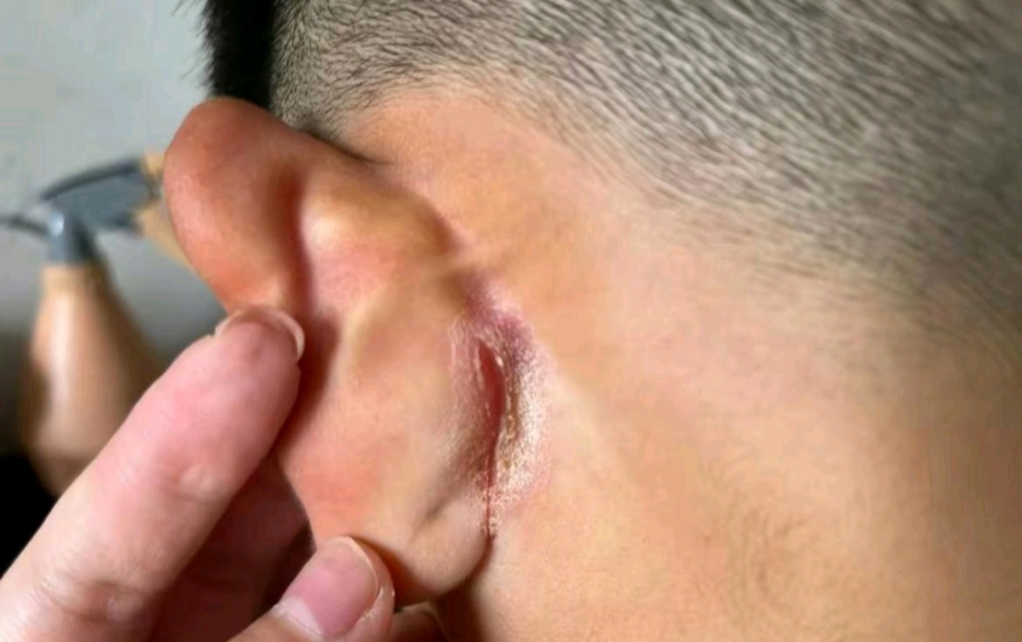 老师把孩子的耳朵撕成这样,要不要找校长呢?