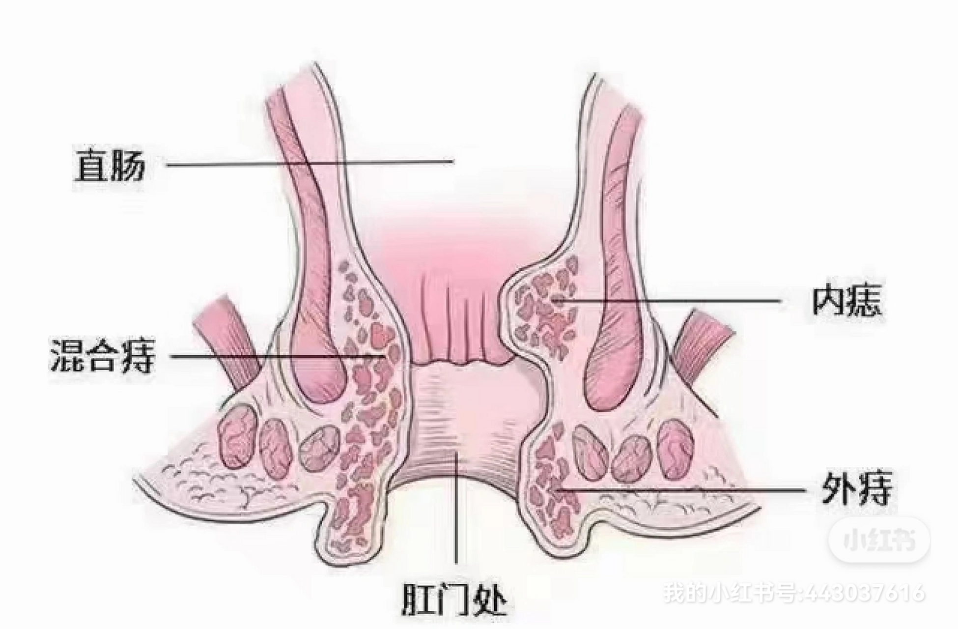 血栓性外痔 早期图片