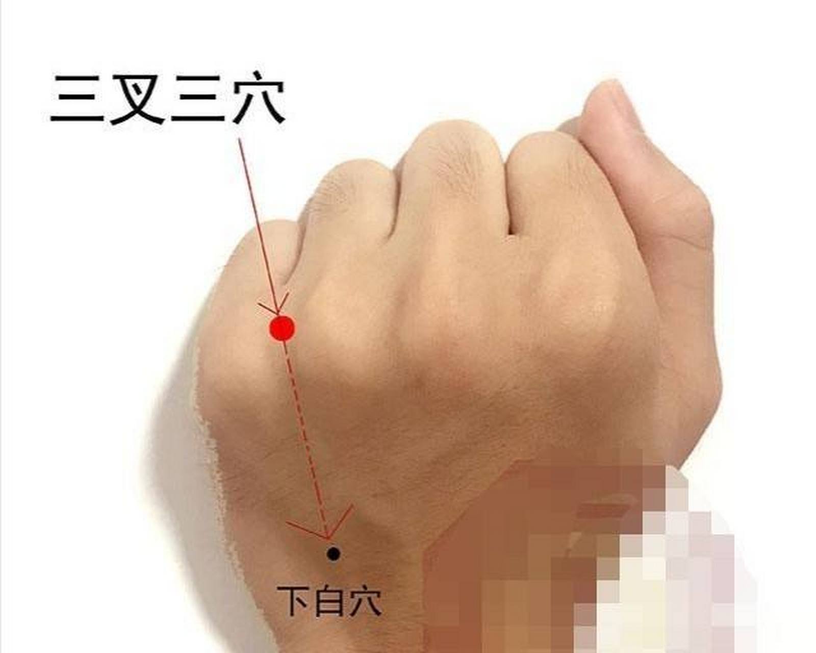 感冒的两组针灸方: ①三叉三 土水中穴(土水二穴) ②木穴 三叉三穴