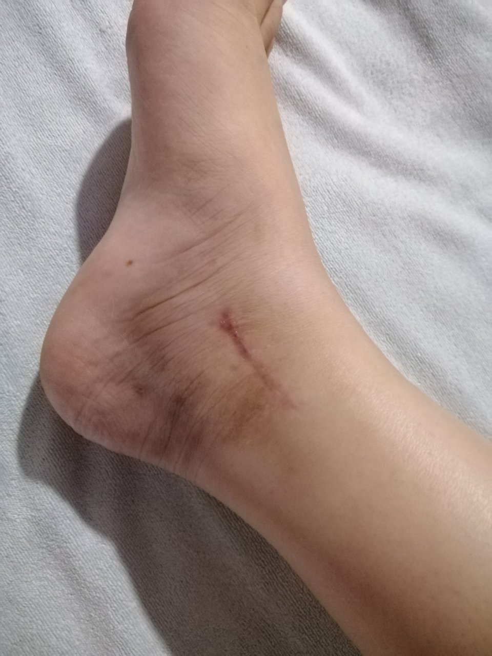 今天是我三踝骨折手术后的一百天,现在还是单拐走路,天天走点路就肿的