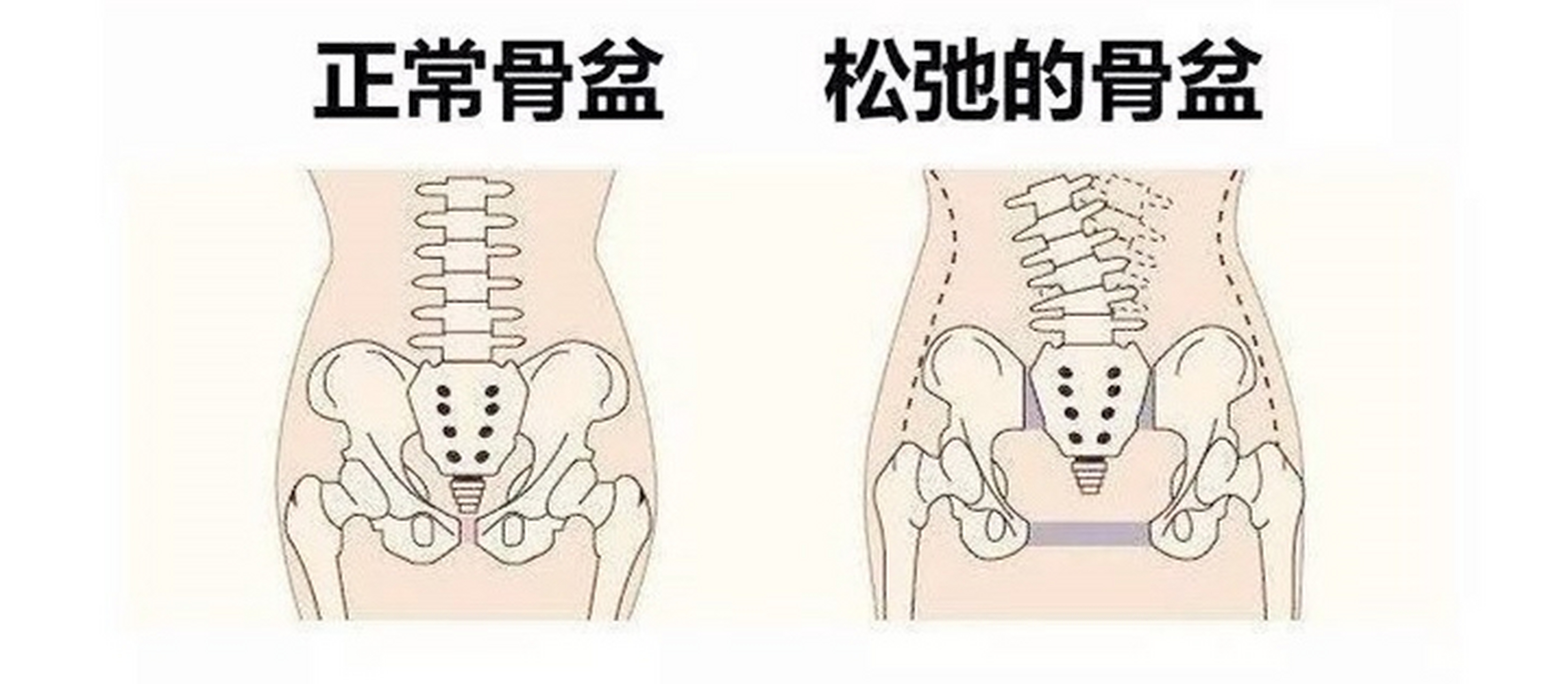 生完孩子后,在家做骨盆训练行吗?