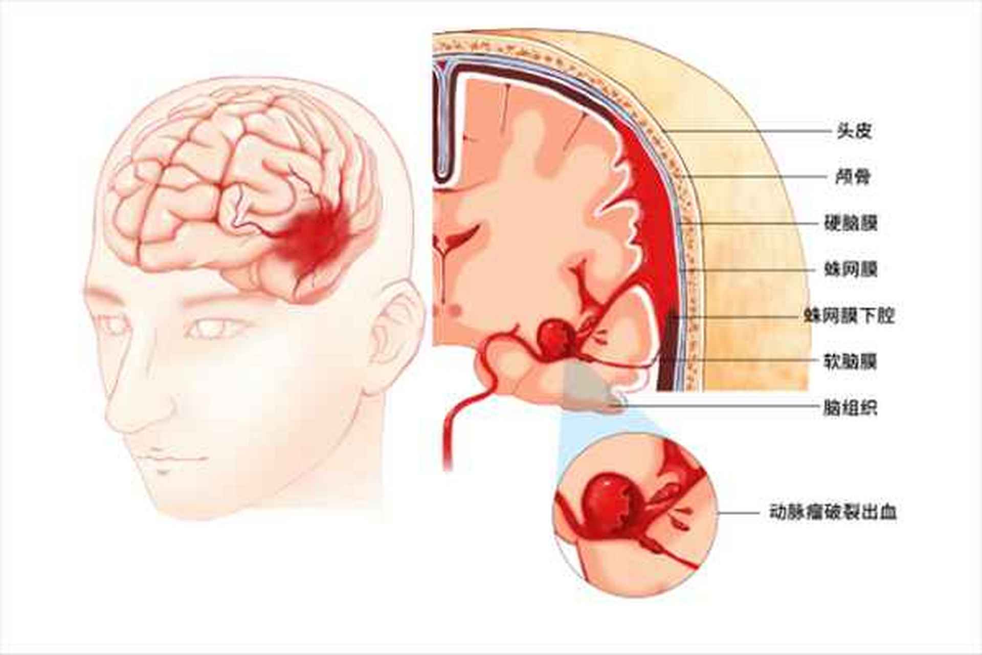 蛛网膜下腔出血是脑出血吗?