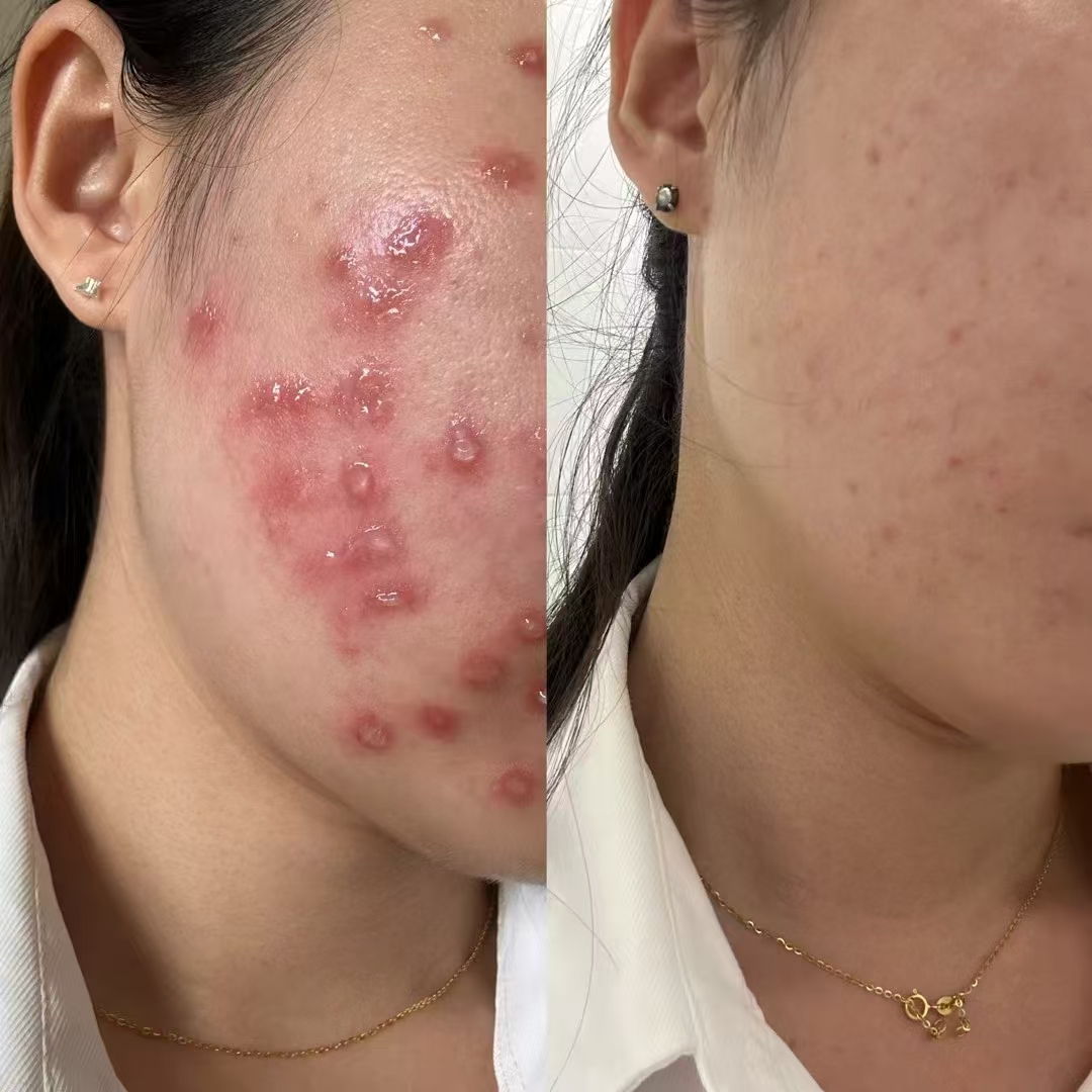 蜂蜜与皮肤过敏的关系(蜂蜜跟什么过敏) 蜂蜜与皮肤过敏的关系(蜂蜜跟什么过敏)