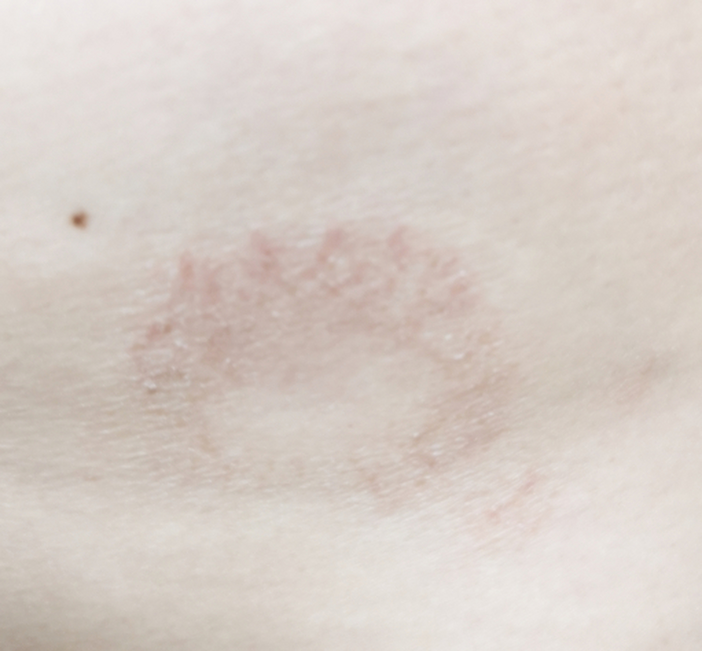 我身上老是起这种暗红色的"圆圈",发起来的时候有点痒,有点掉皮