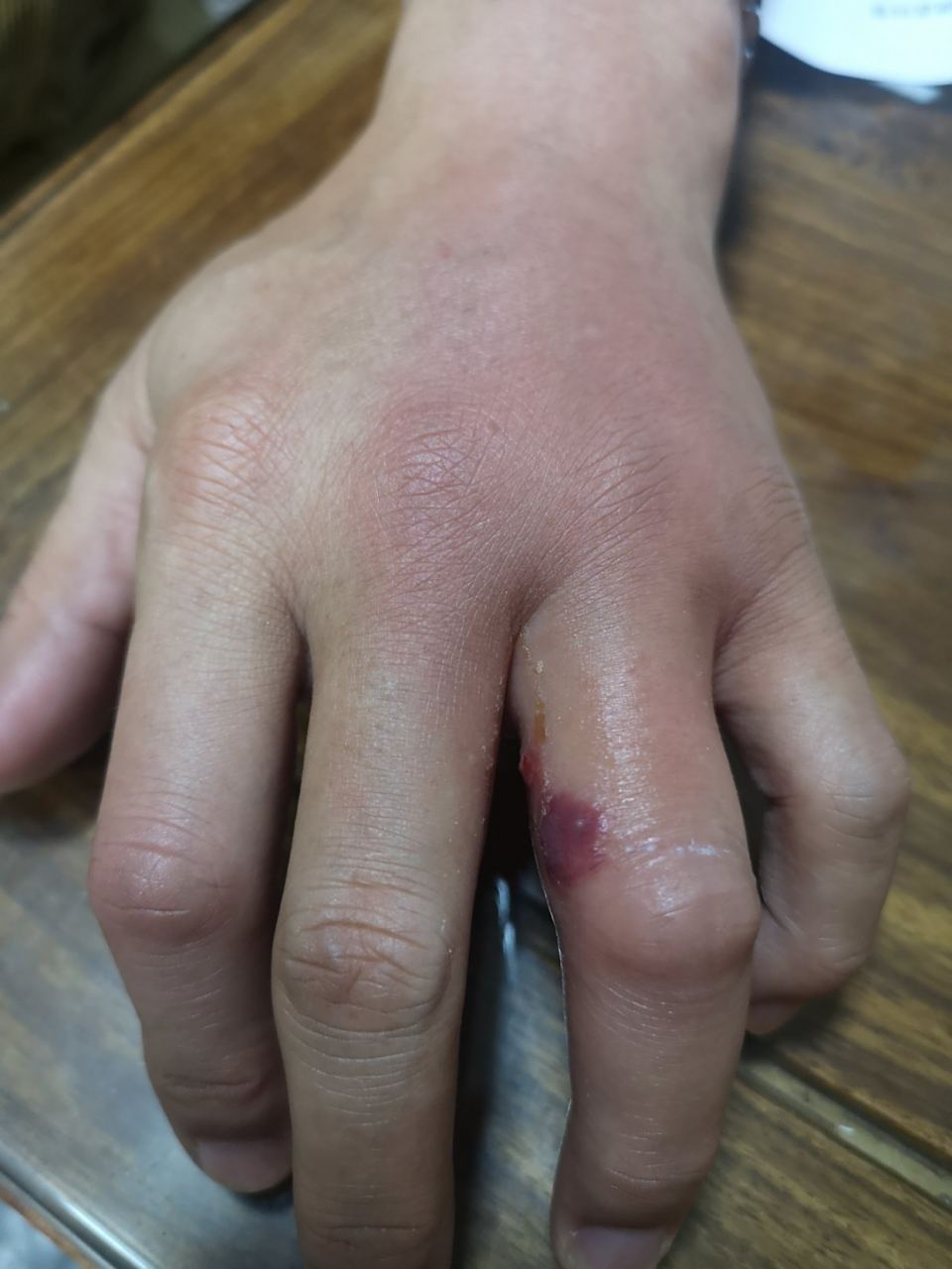 一来到诊室就说,前一天左手不小心被红火蚁咬伤后就红肿,疼痛,起水泡