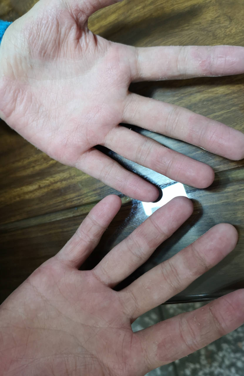 老是脱皮,他还哭嚷说很痒,有时候疼,喜欢抓,抓破以后会流水,久了手掌