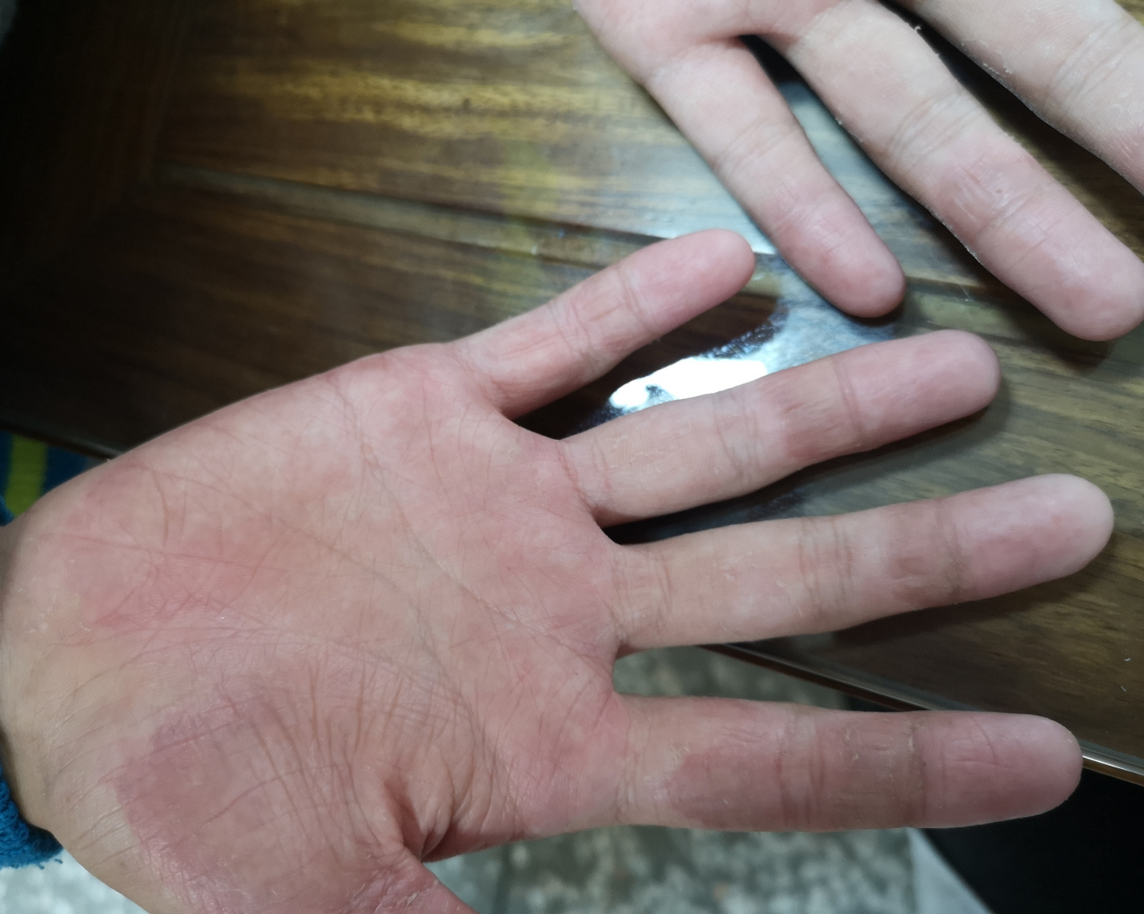 老是脱皮,他还哭嚷说很痒,有时候疼,喜欢抓,抓破以后会流水,久了手掌