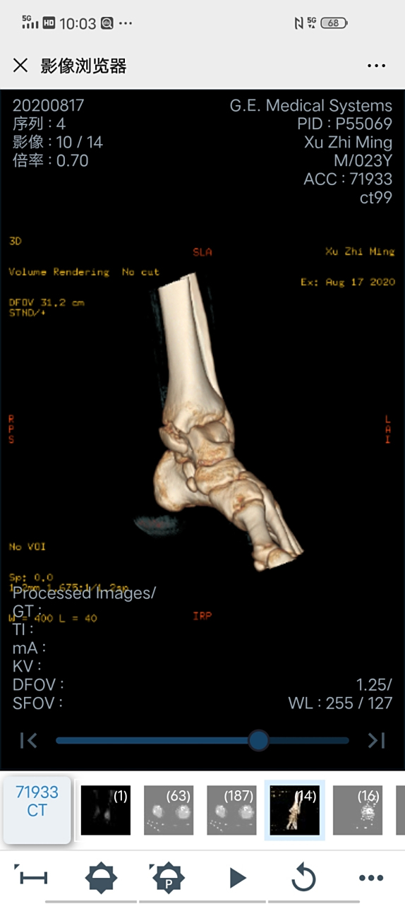 这螺丝骨必须要手术吗?