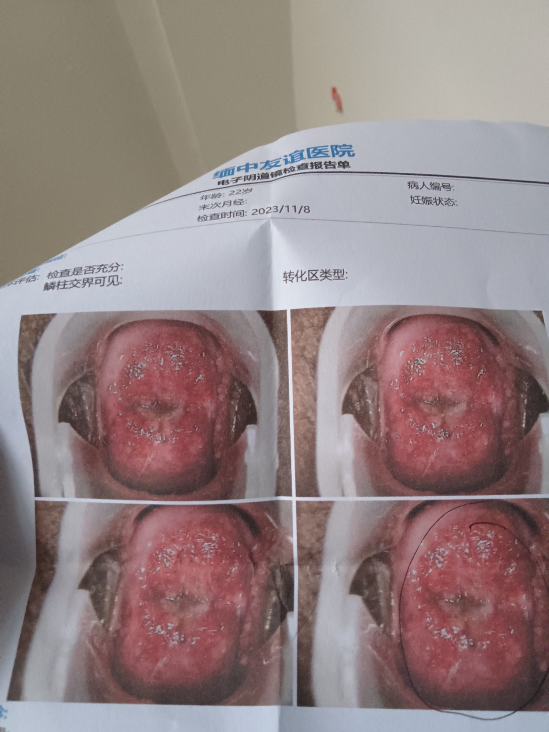 宫颈糜烂,各位专家帮忙看看这样要动手术吗