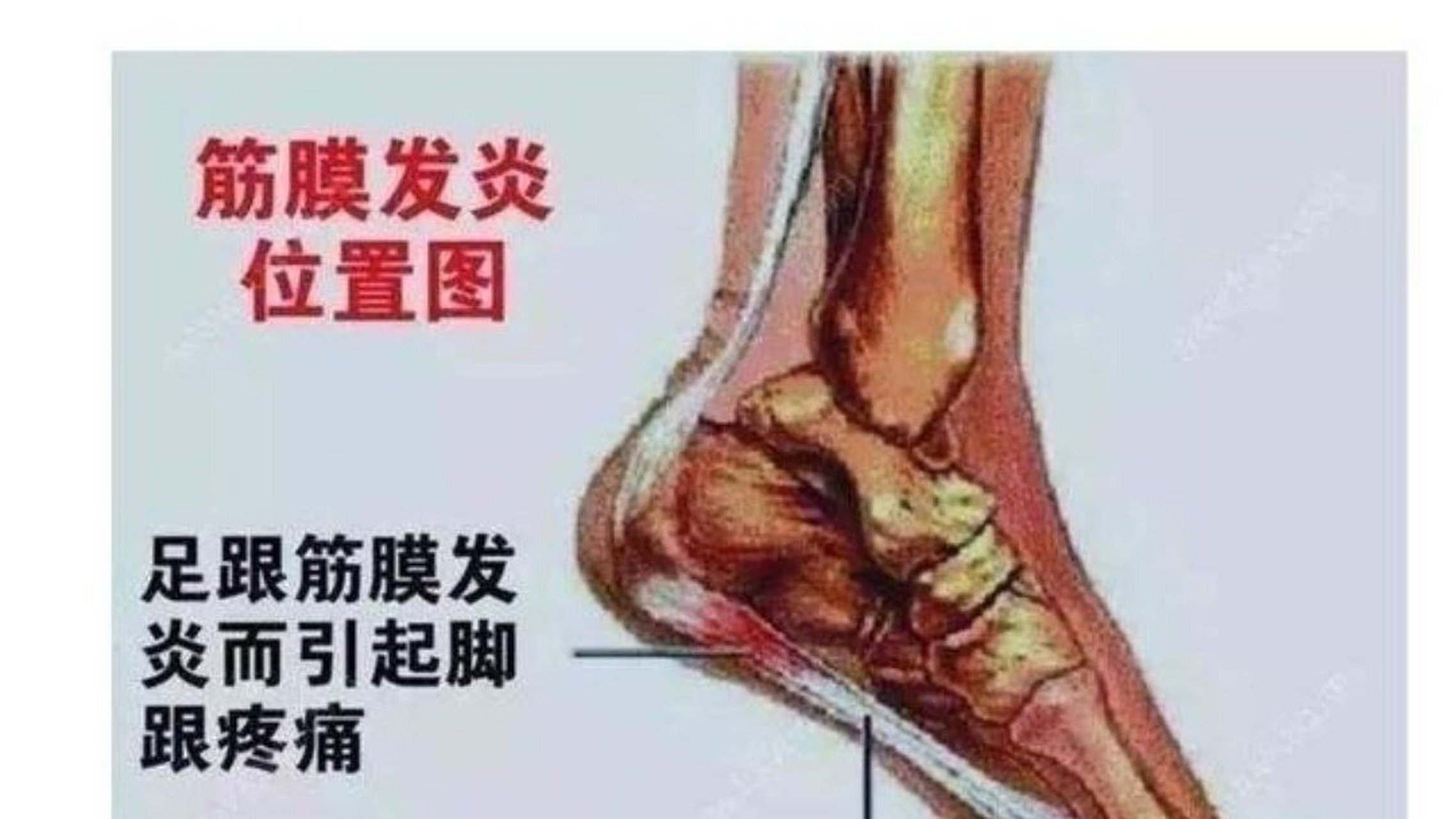 足底筋膜炎痛点图片: 足底筋膜炎是足底的肌腱或者筋膜发生无菌性炎症