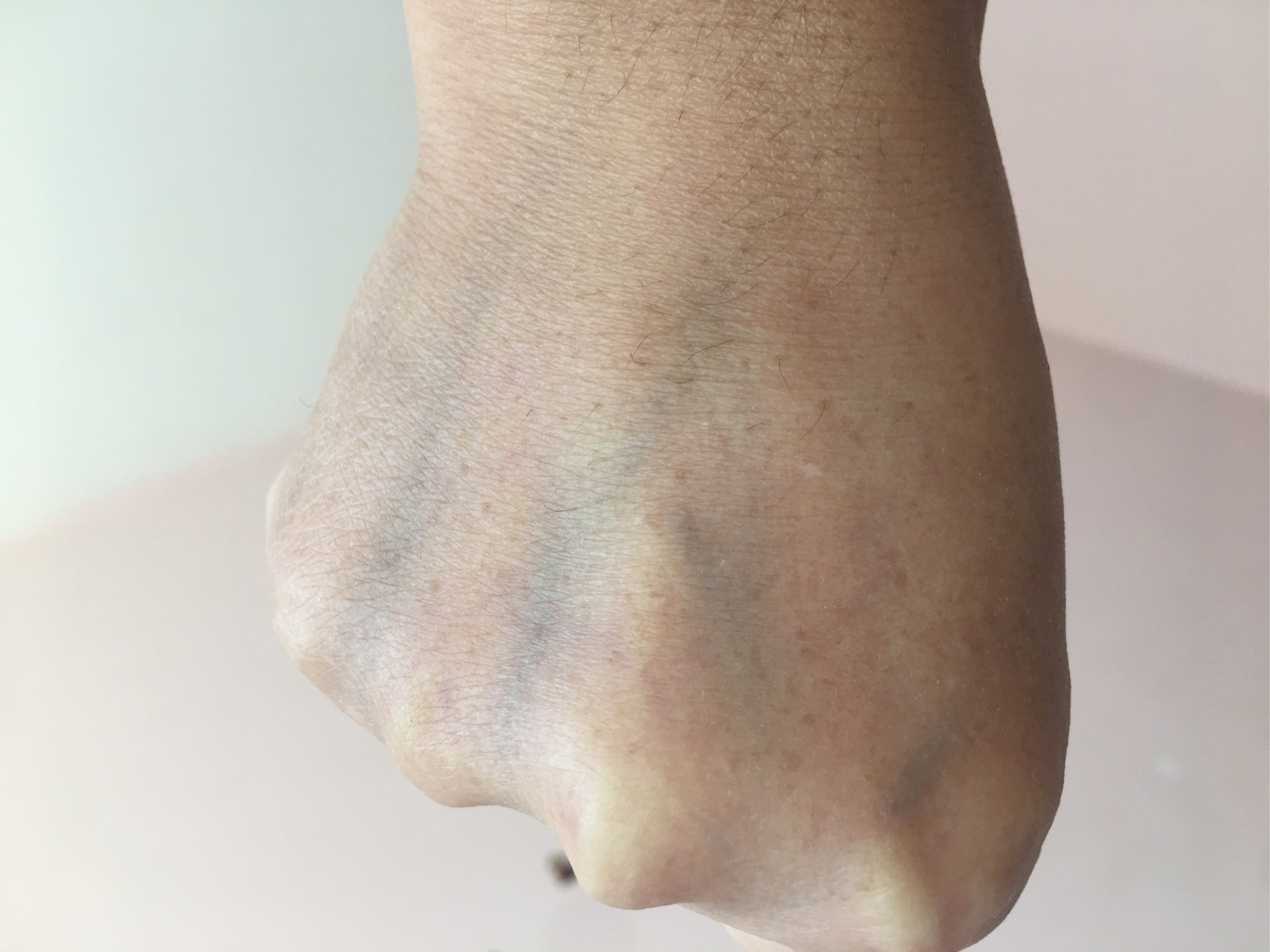 这是扁平疣吗?还是什么别的,手背好多,用手摸不出来只能看出来!