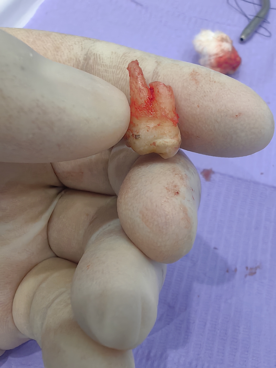 医院通报“患者拔牙后创伤有棉球留传”：涉事医师停诊处理已当面向患者致歉