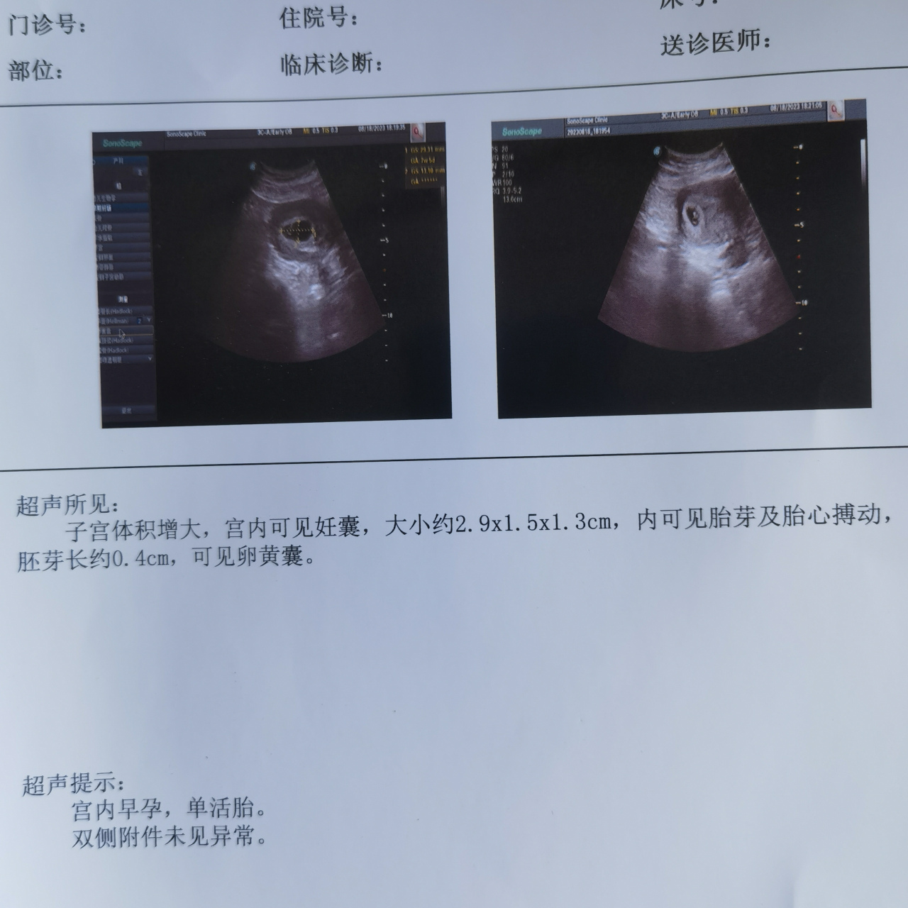 怀孕47天,孕囊2.9*1.5*1.3是男孩女孩
