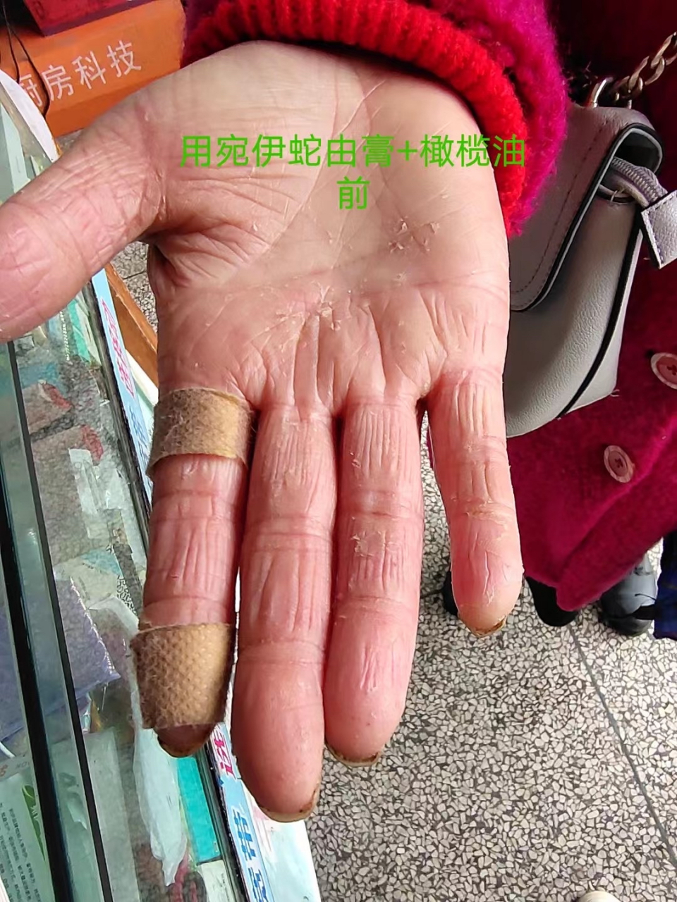 阿姨手受伤没办洗澡