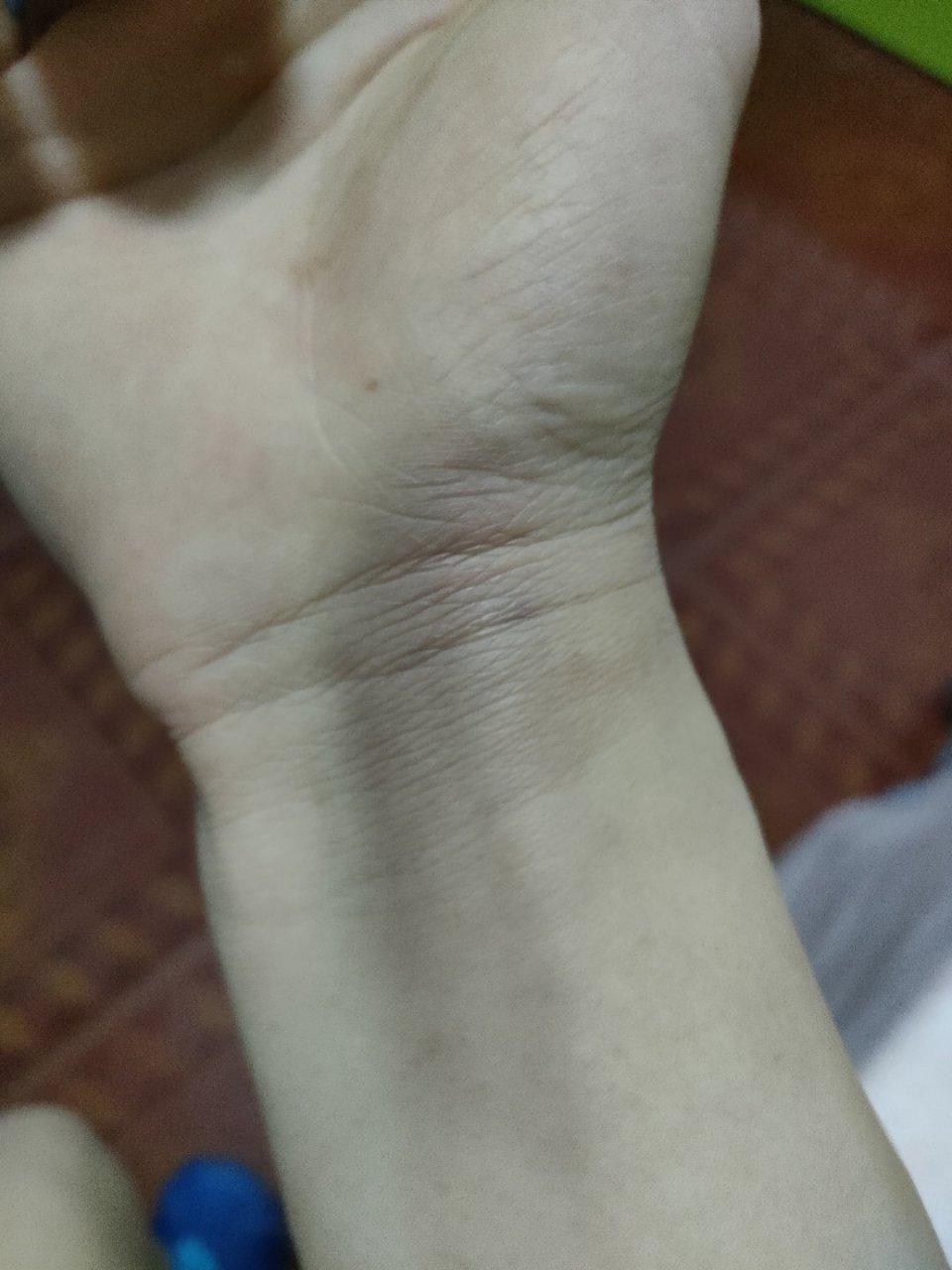 手腕突然淤青是怎么回事谁知道?