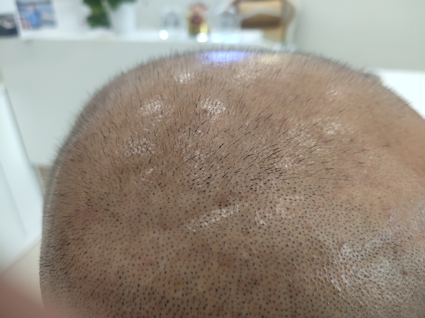 生发植发种发(生发植发的效果)