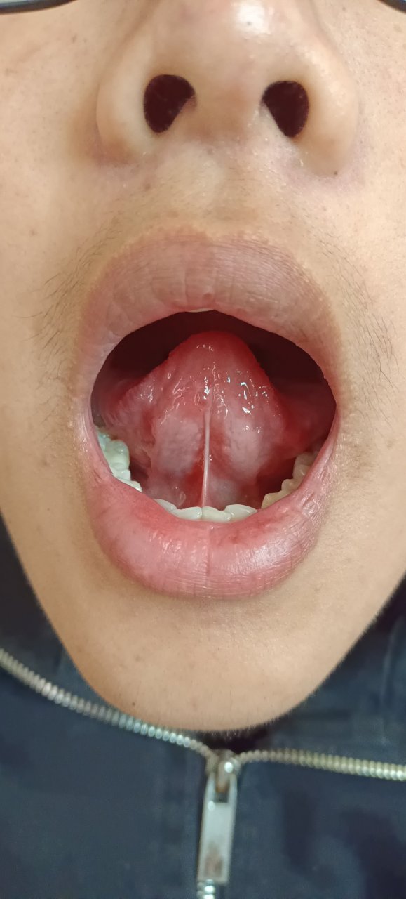 舌头上长了一个痘痘,做了小手术两个星期又长了,是怎么回事