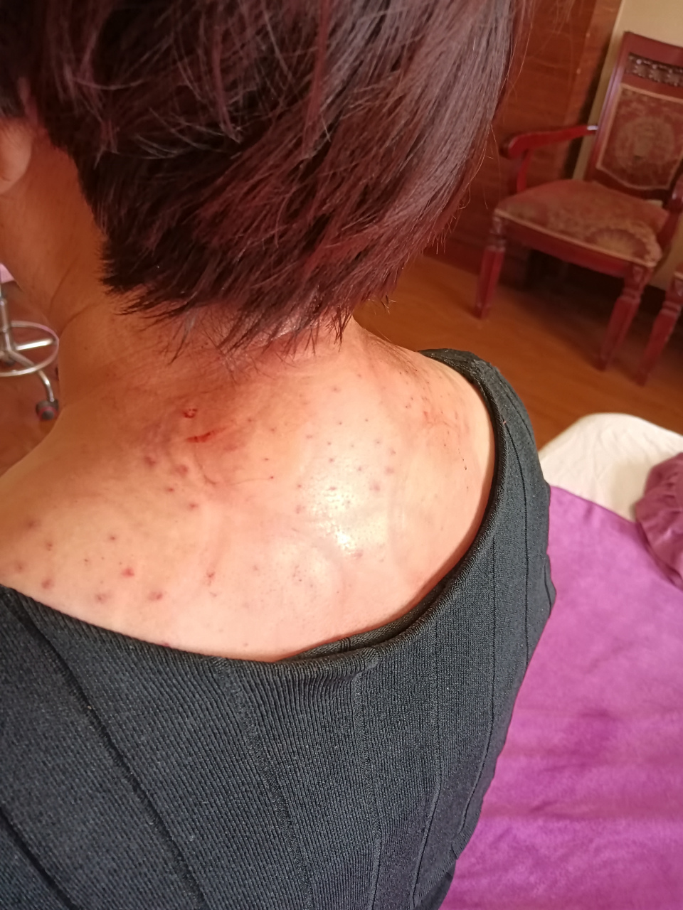 颈椎突出正骨复位后按摩拔罐,特大富贵包