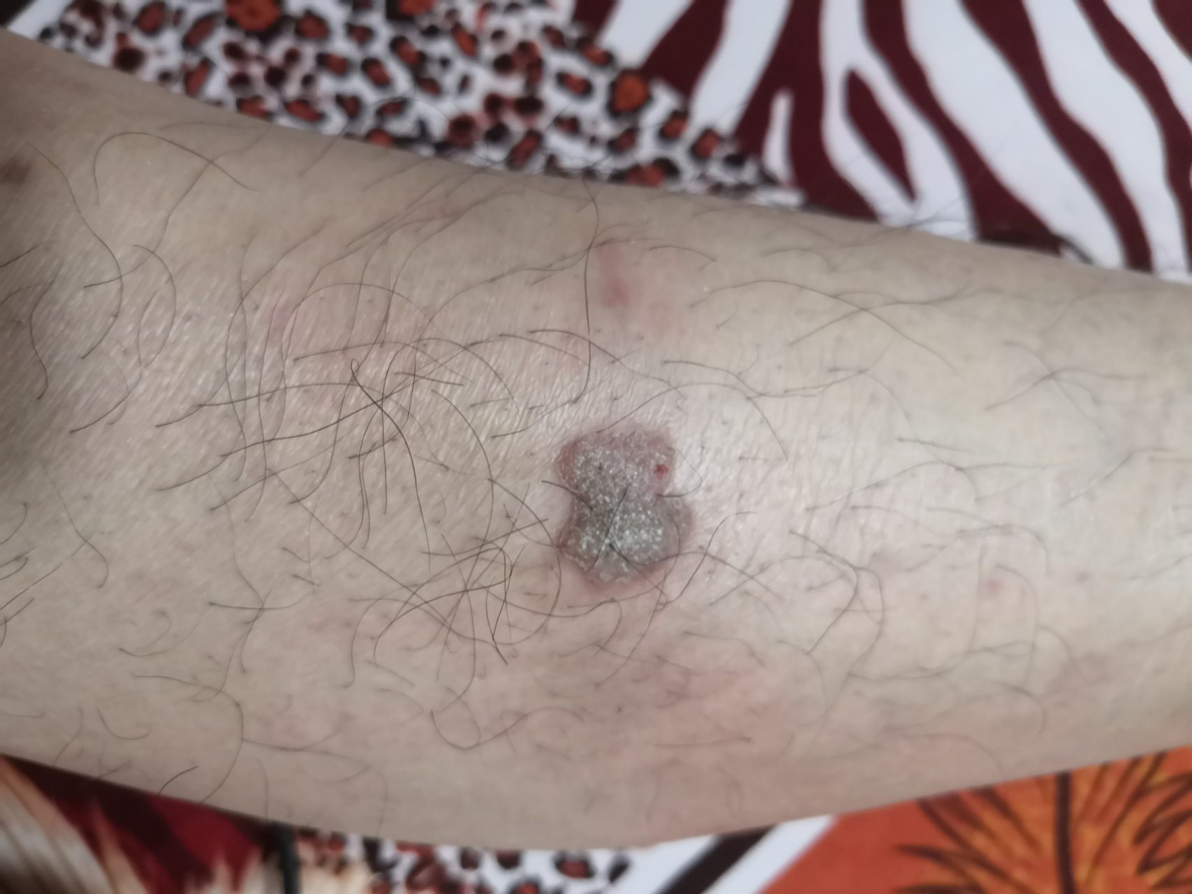 小腿上长了几个褐色的疙瘩不疼不痒请问哪位高人这是什么原因引起的?