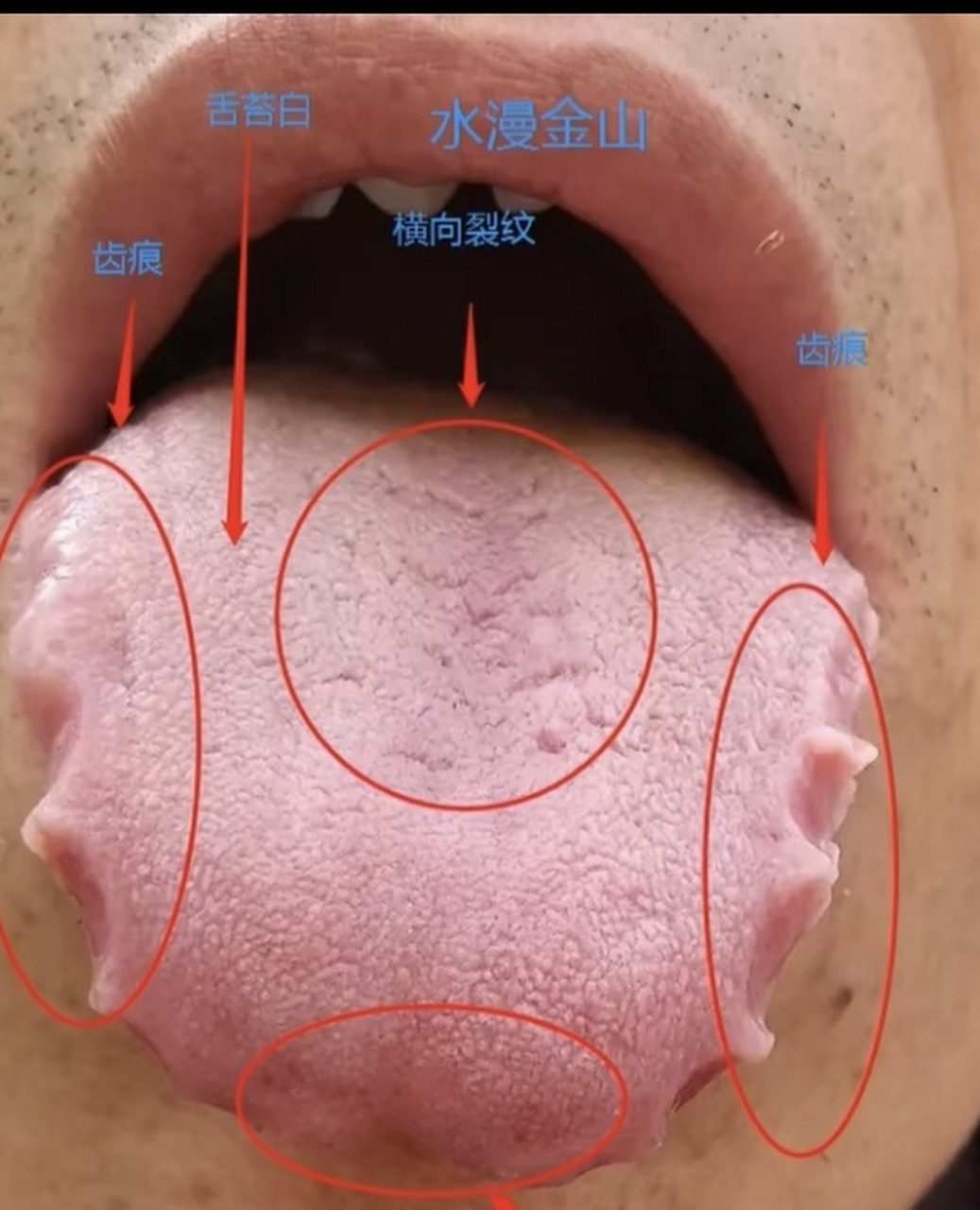 舌头有齿痕是怎么回事图片