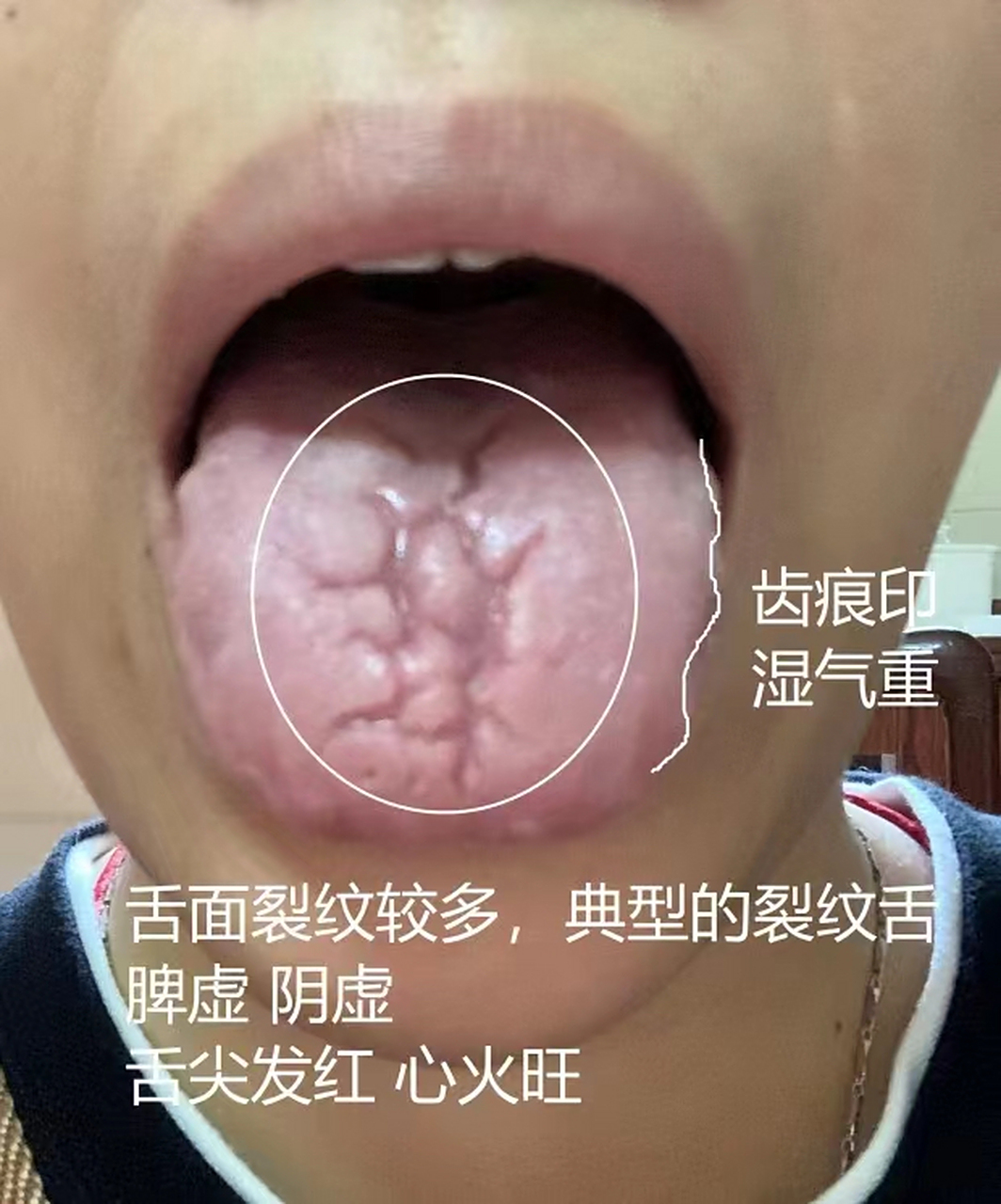 舌头裂纹多是怎么回事?#肾虚# #裂纹舌