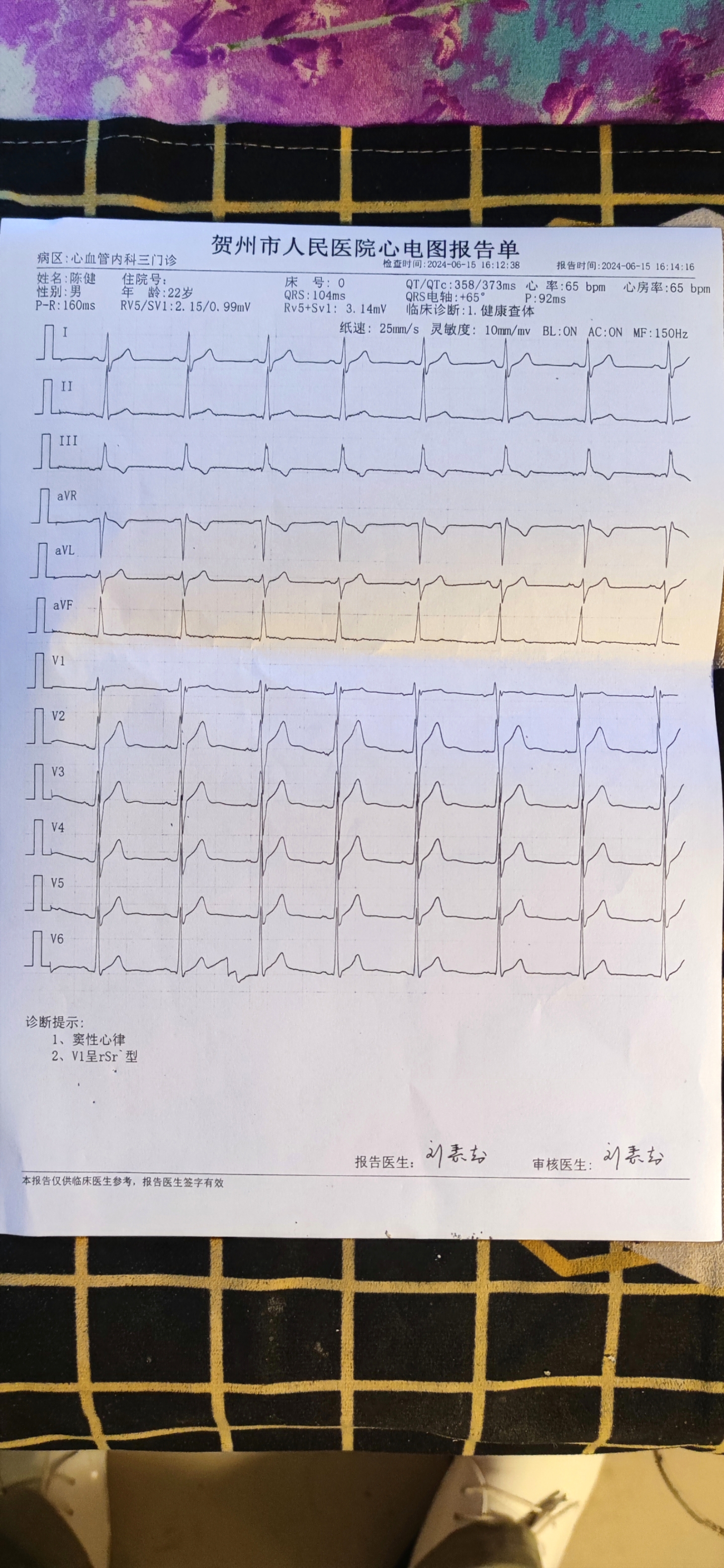 这心电图征兵能通过吗?