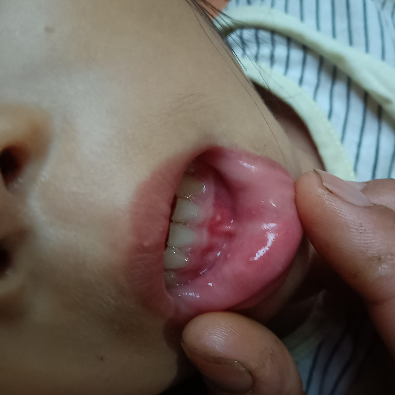 满嘴的溃疡,舌头也有,天天喊嘴巴痛,吃也吃不了东西,要不是婆婆得癌症