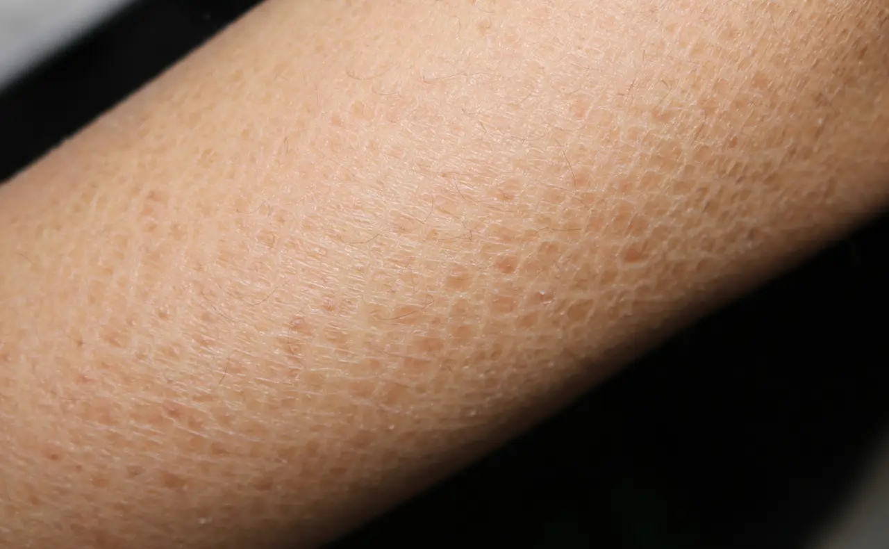 作为一个皮肤科医生,我经常遇到一些患者皮肤干燥粗糙,经常掉皮屑