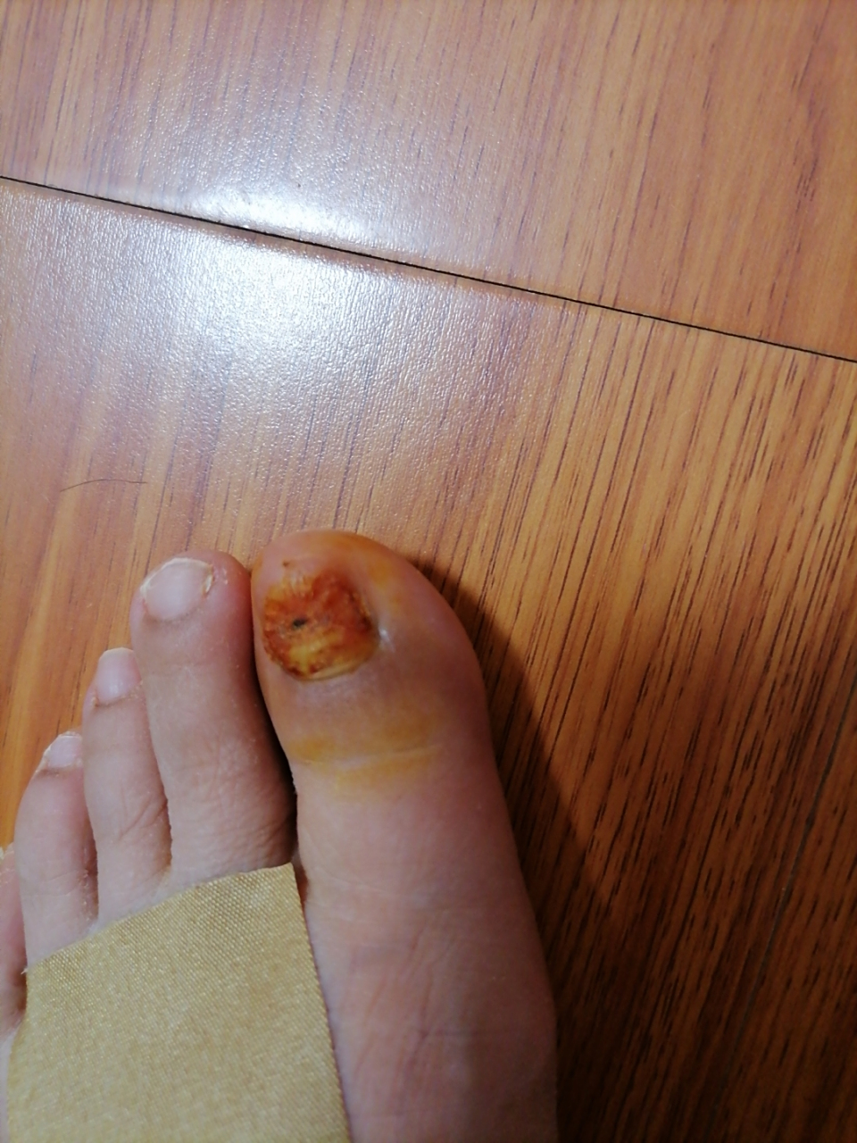 记录甲沟炎拨甲26天后恢复过程 本人因甲沟炎拨甲,其实拨指甲时不痛