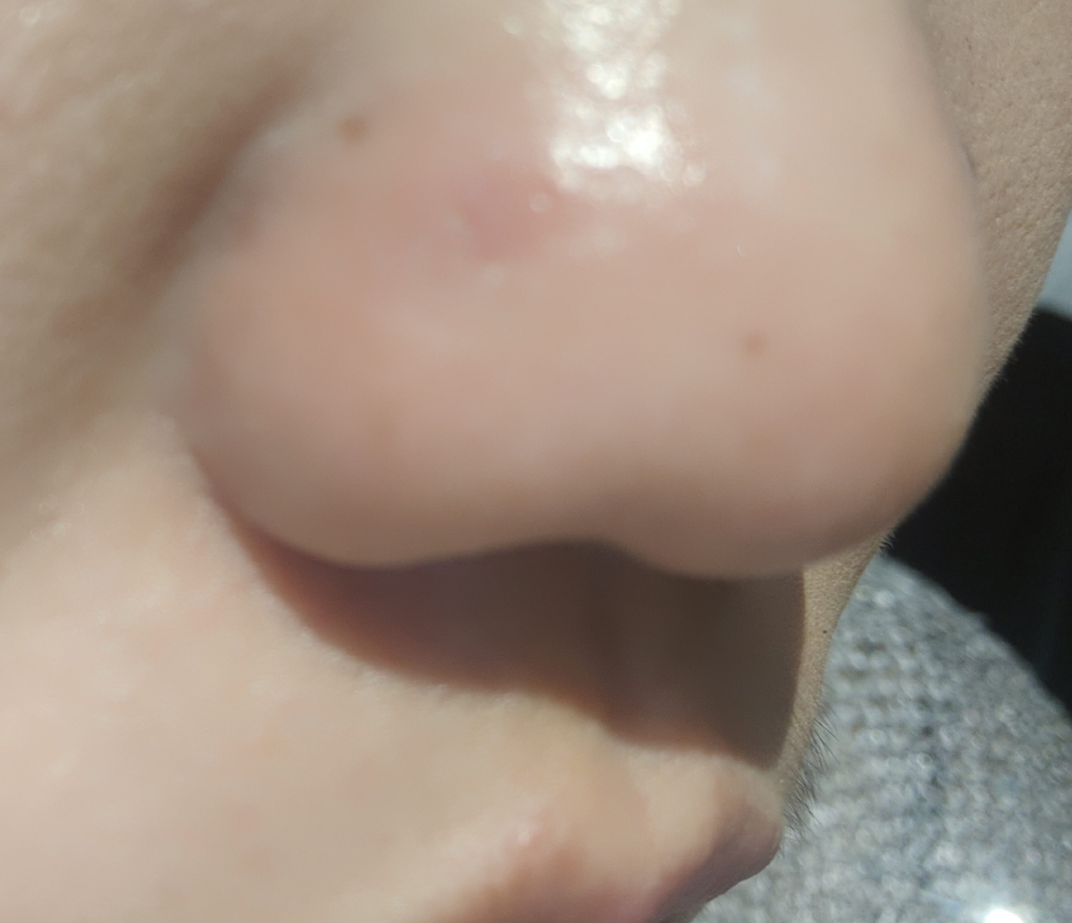 鼻子总长这个包,又红又肿,木木的疼,有知道这是什么原因引起的,怎么