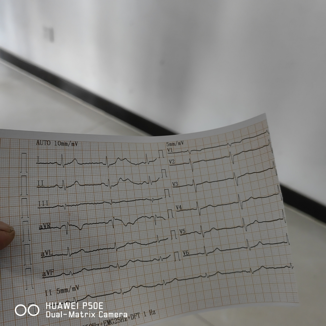 因为心电图被拒入职图片