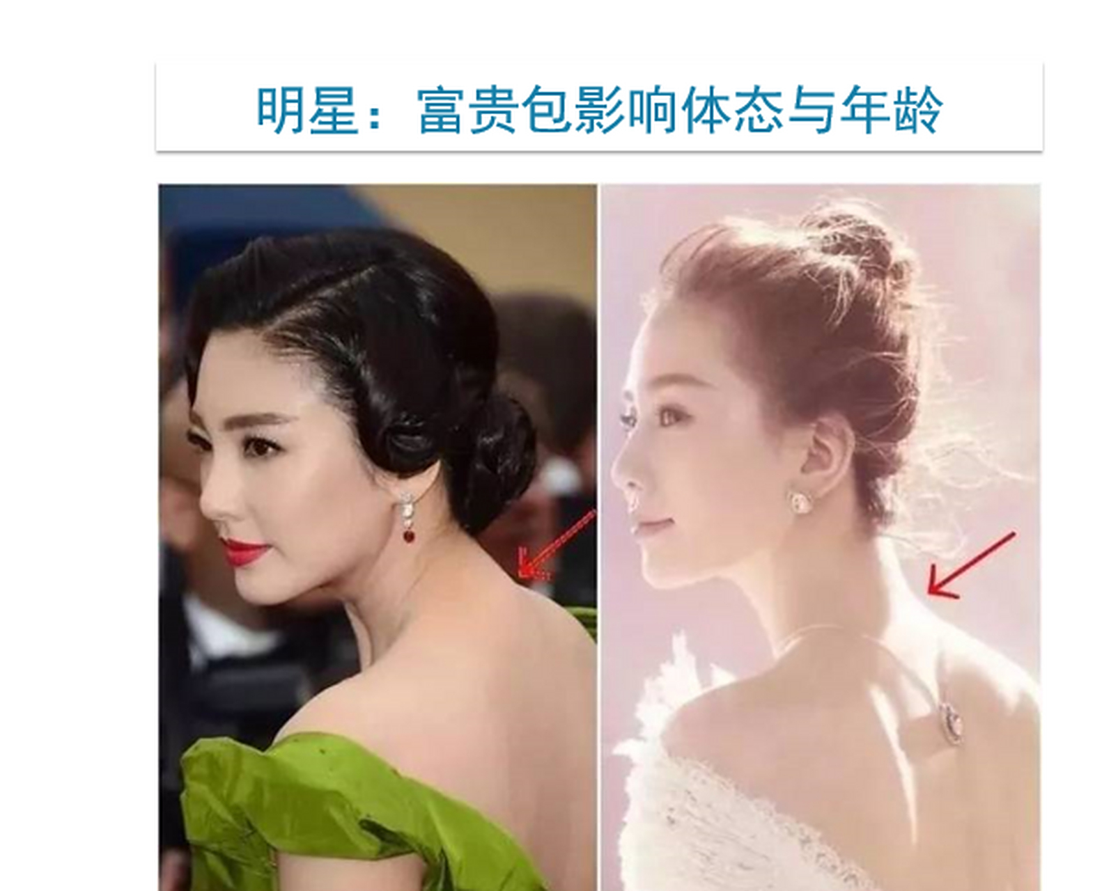 张雨绮,刘诗诗都是87年生人 看看富贵包和脖子,体态和年龄上有没有