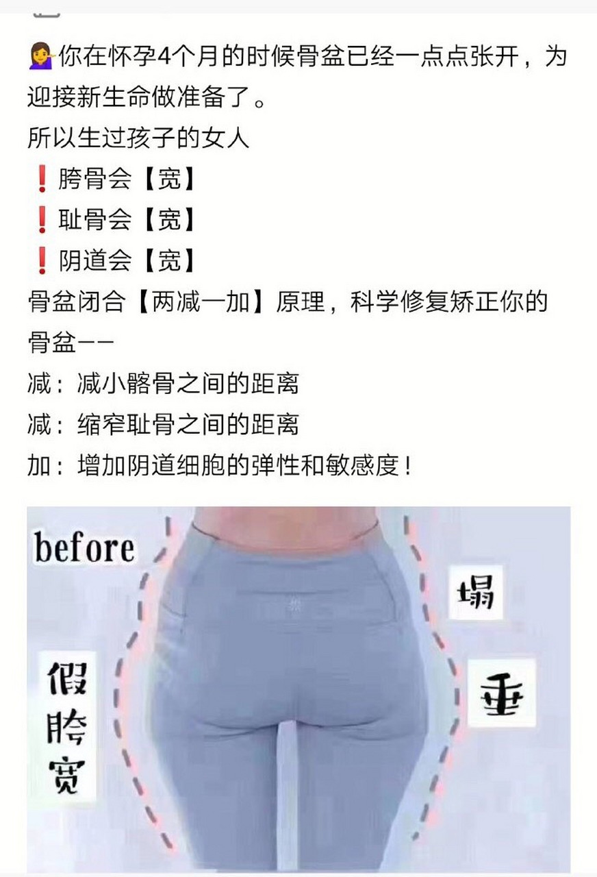 不管顺产还是剖腹产,骨盆都会逐渐外翻!产后骨盆修复必不可少!