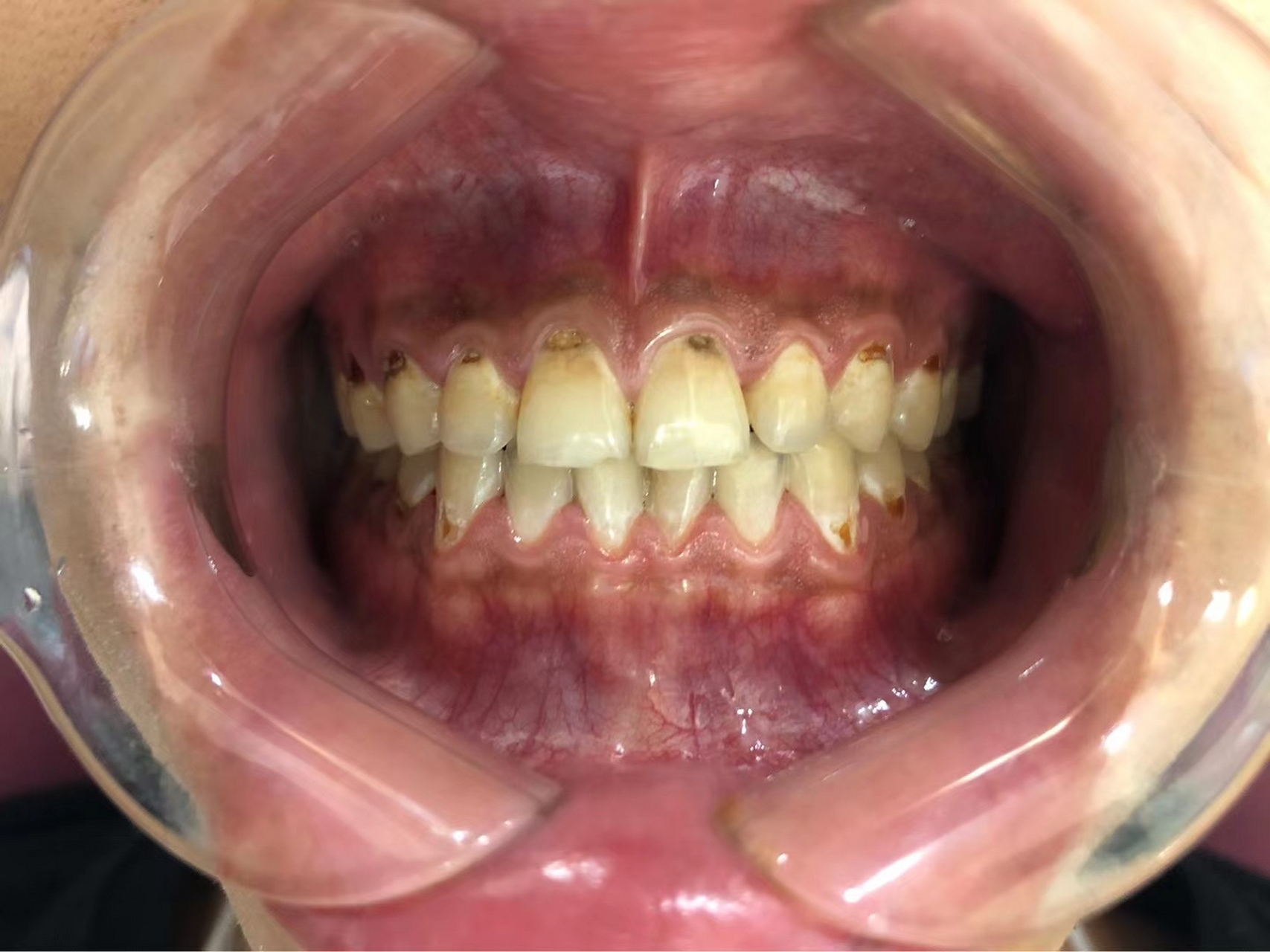 爱佳口腔"可乐牙"～完美