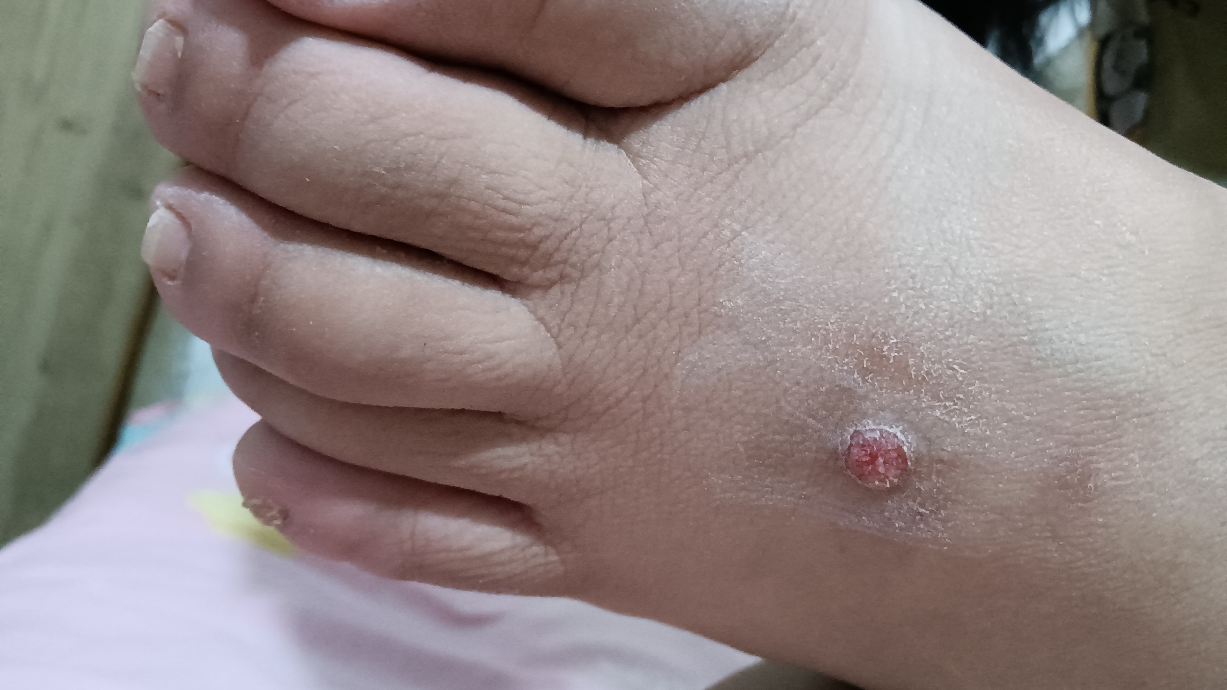脚背上长了一个软软的包,不疼,很痒,我把它抓破了皮,里面的肉像是海绵