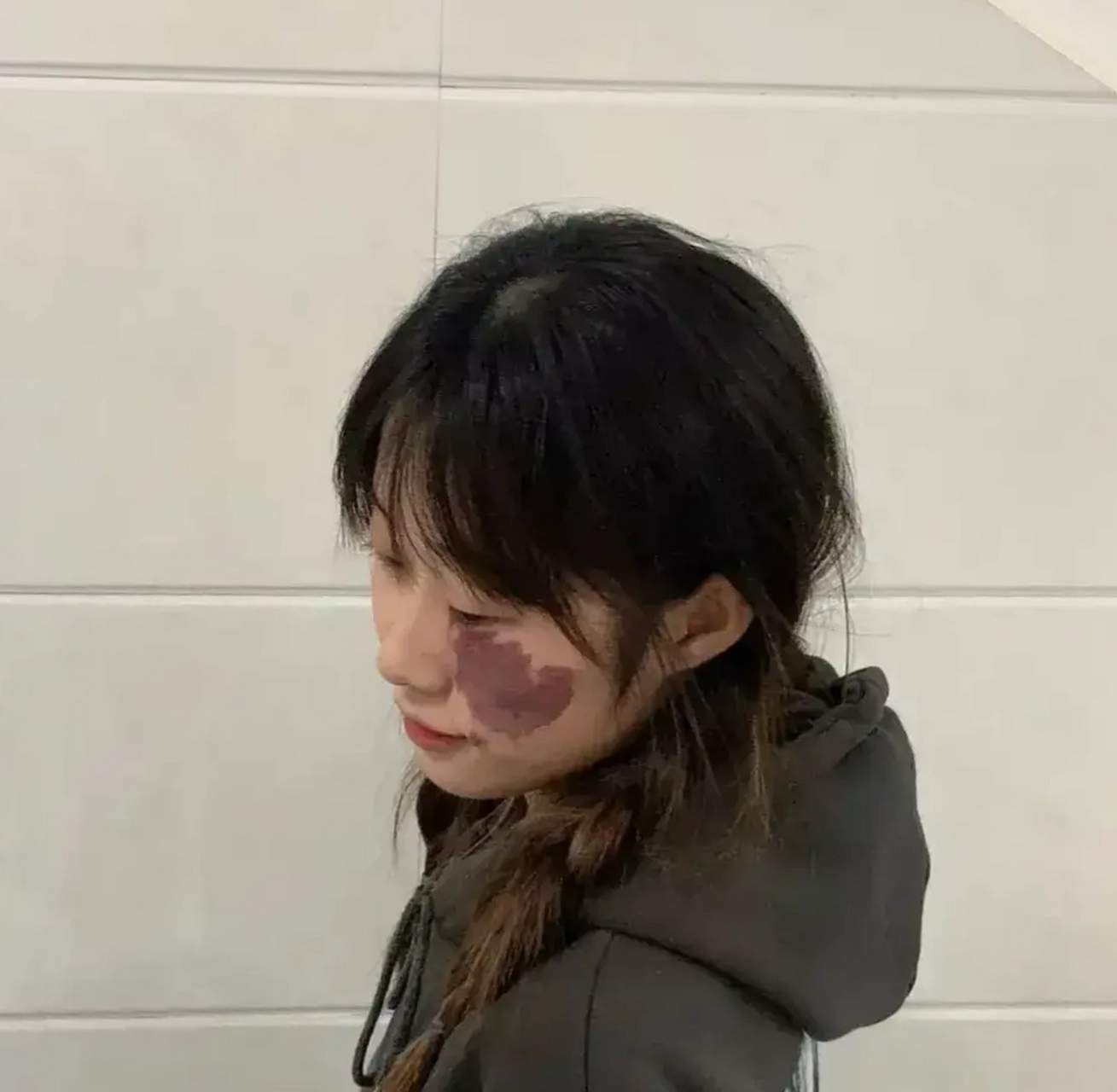 时间过得真快,脸上这块胎记,陪伴了我整整23年.