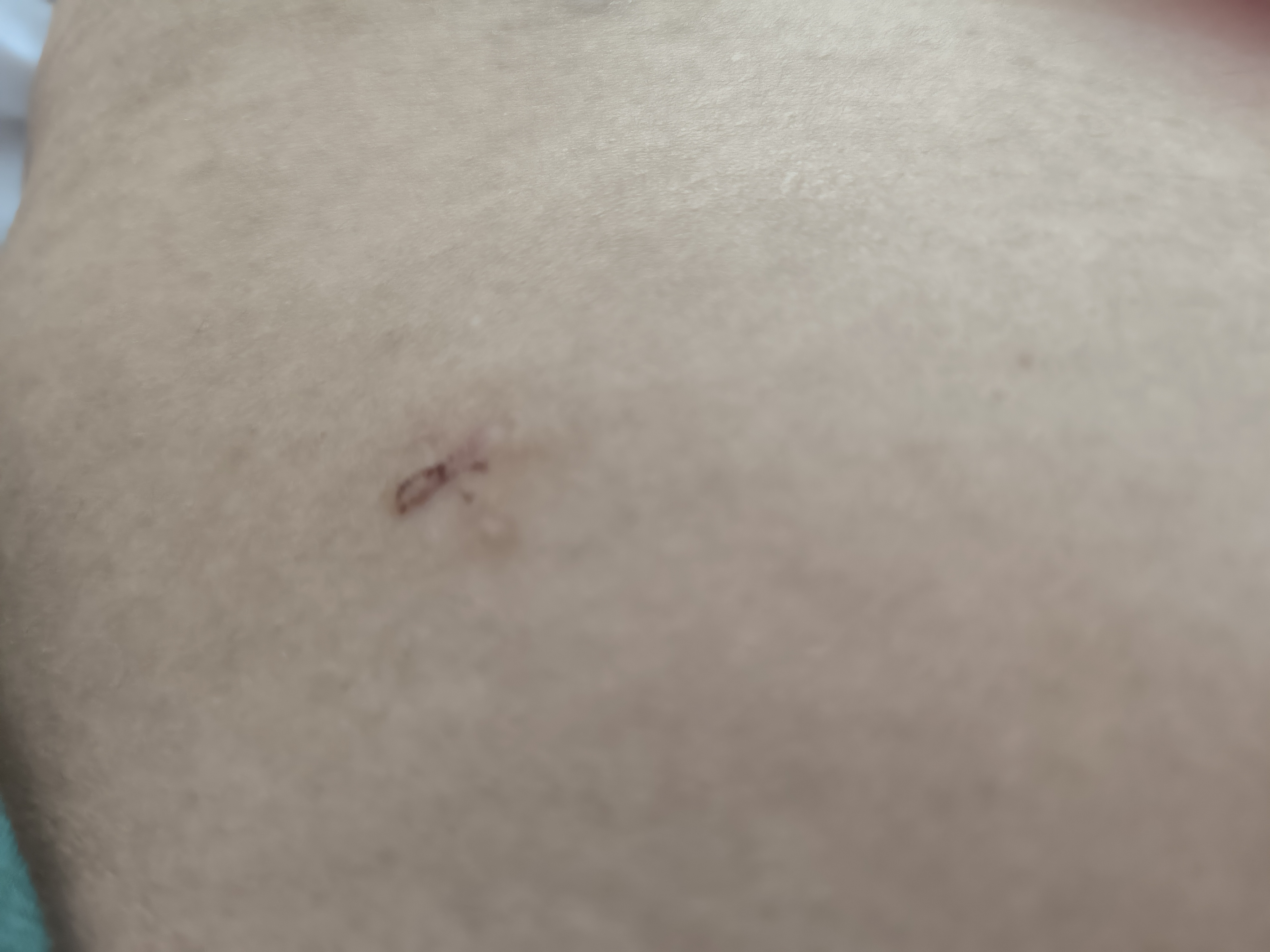 腹腔镜手术第18天伤口,刚开始医生说要做腹腔镜手术很害怕,第一怕疼第