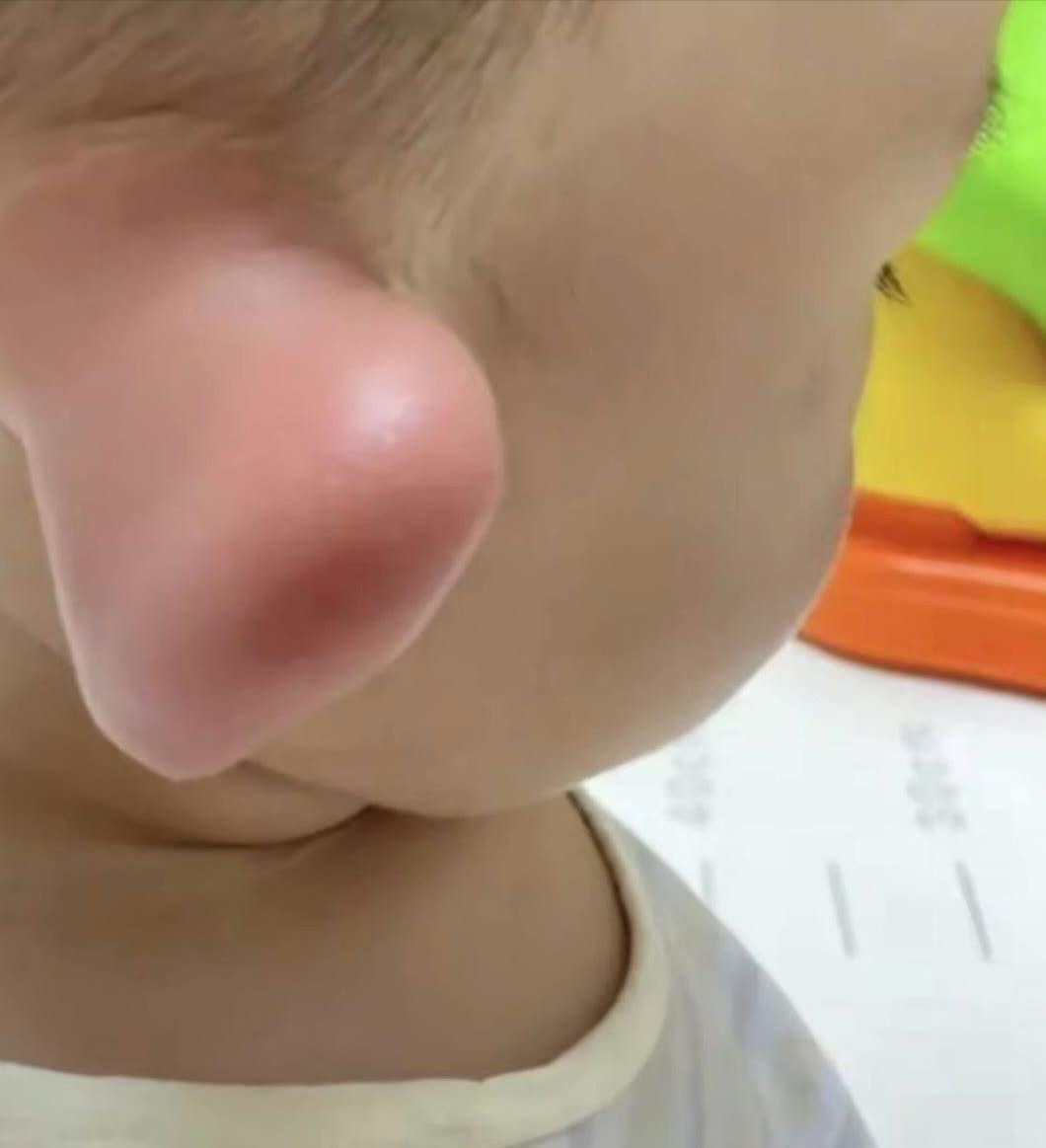 今天在医院里,看见一个小孩,他的耳朵大的出奇,是因为生病红肿了吗?