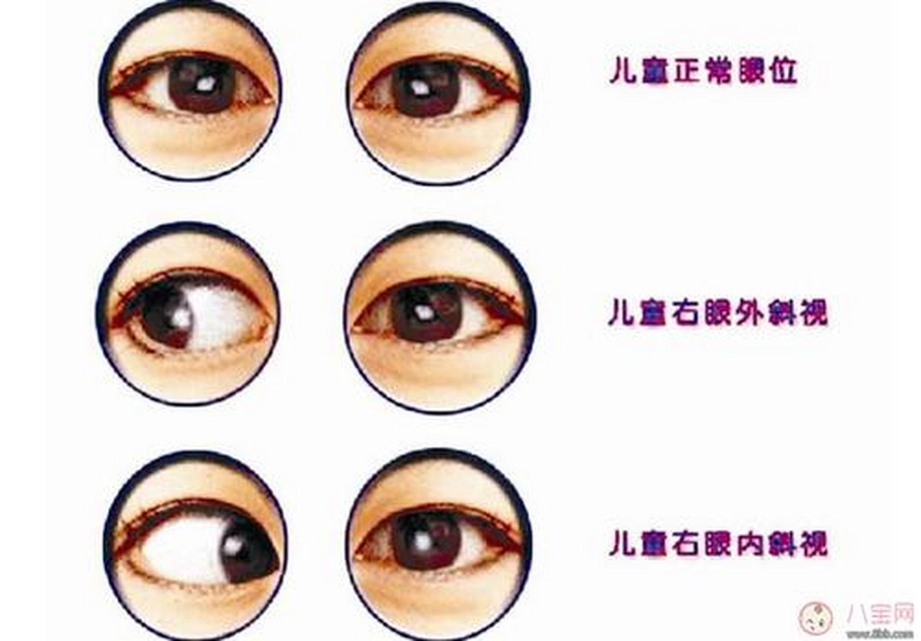 斜视的主要症状: 重轻度的内,外隐斜视不会引起眼睛不舒服,斜度高的才