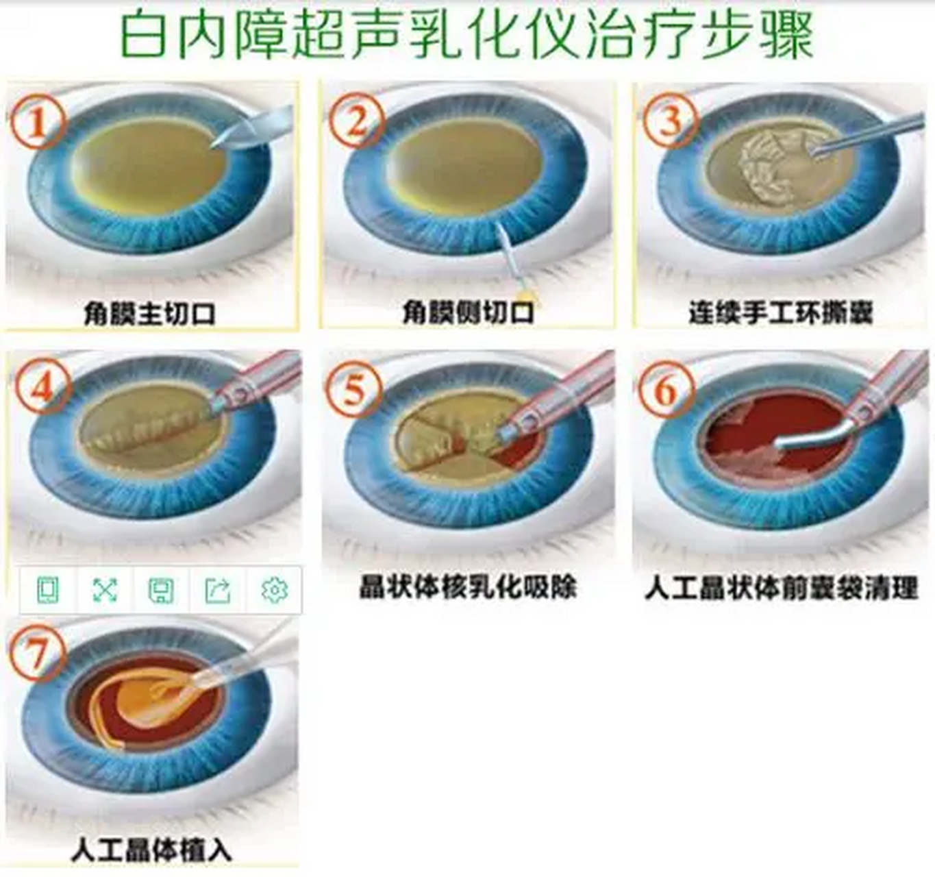 现代白内障手术基本都是超声乳化白内障摘除加人工晶体植入术,一般在
