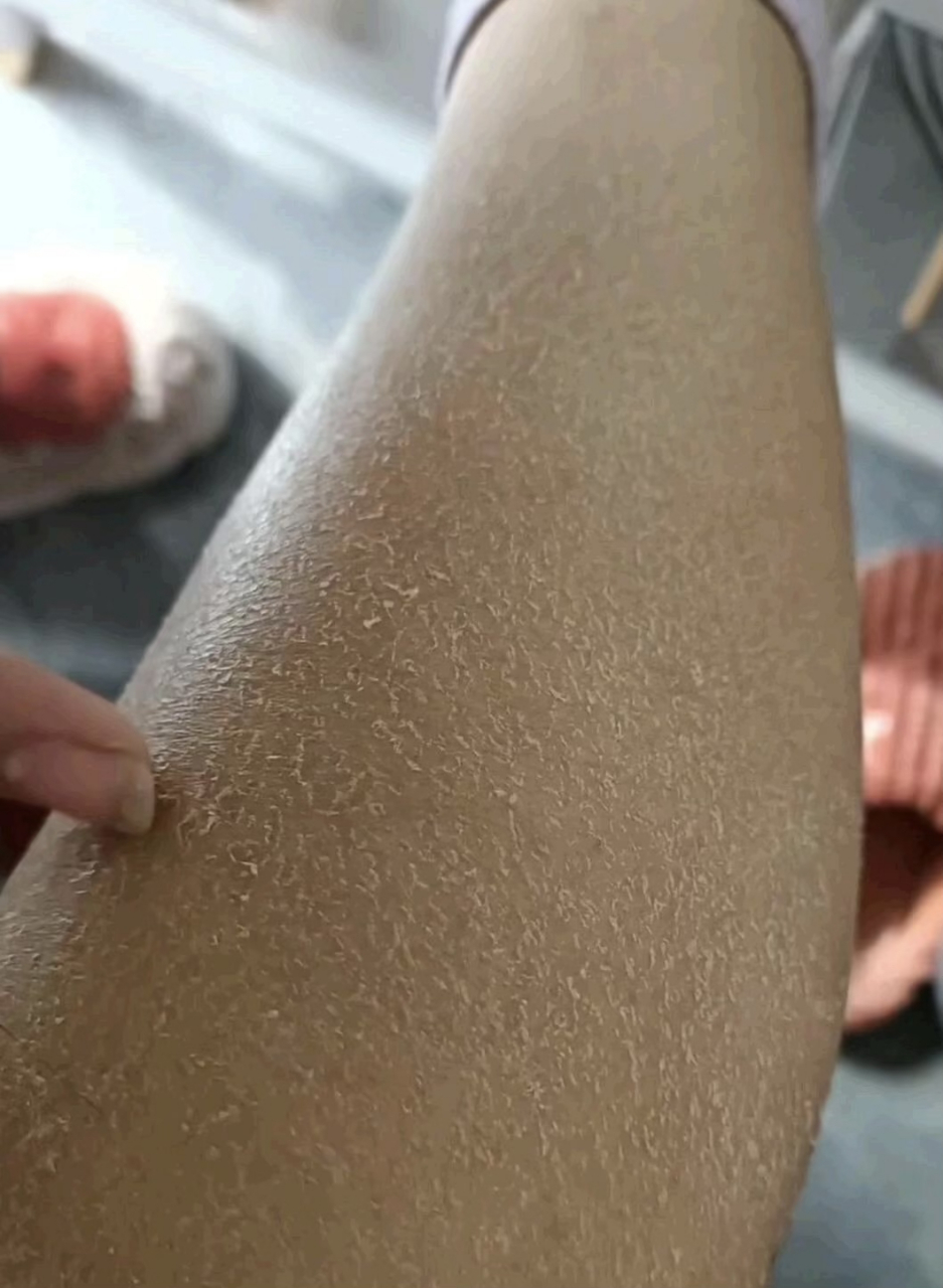 腿皮老是掉,咋回事呀