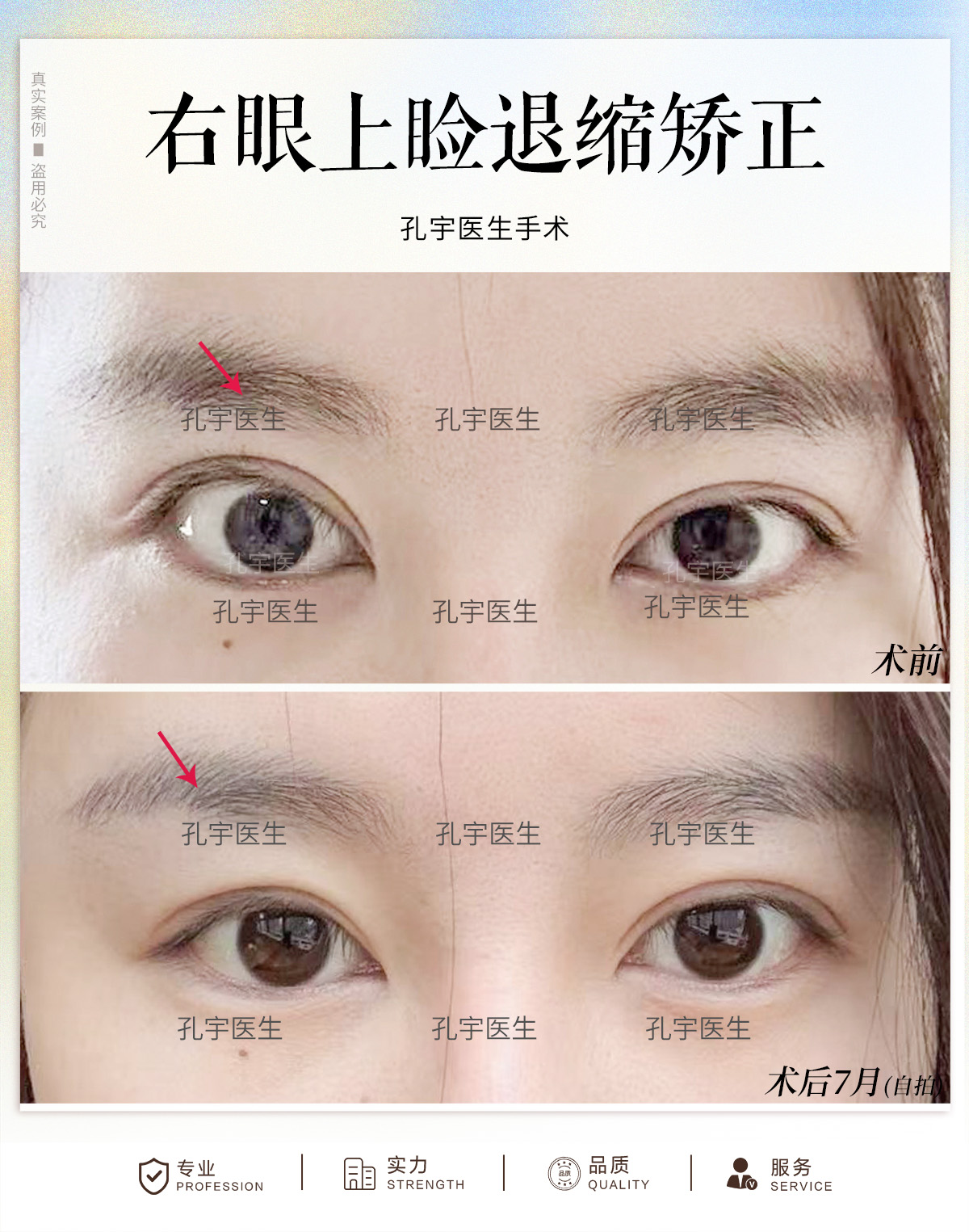 修复后双眼对称.#孔宇双眼皮修复# #双眼皮修复