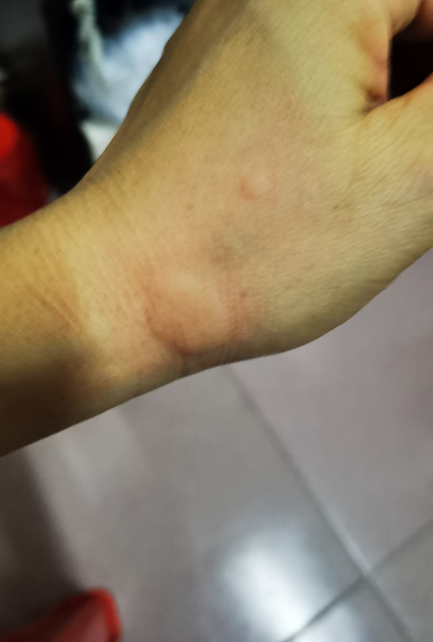 打完新冠疫苗过敏起荨麻疹.