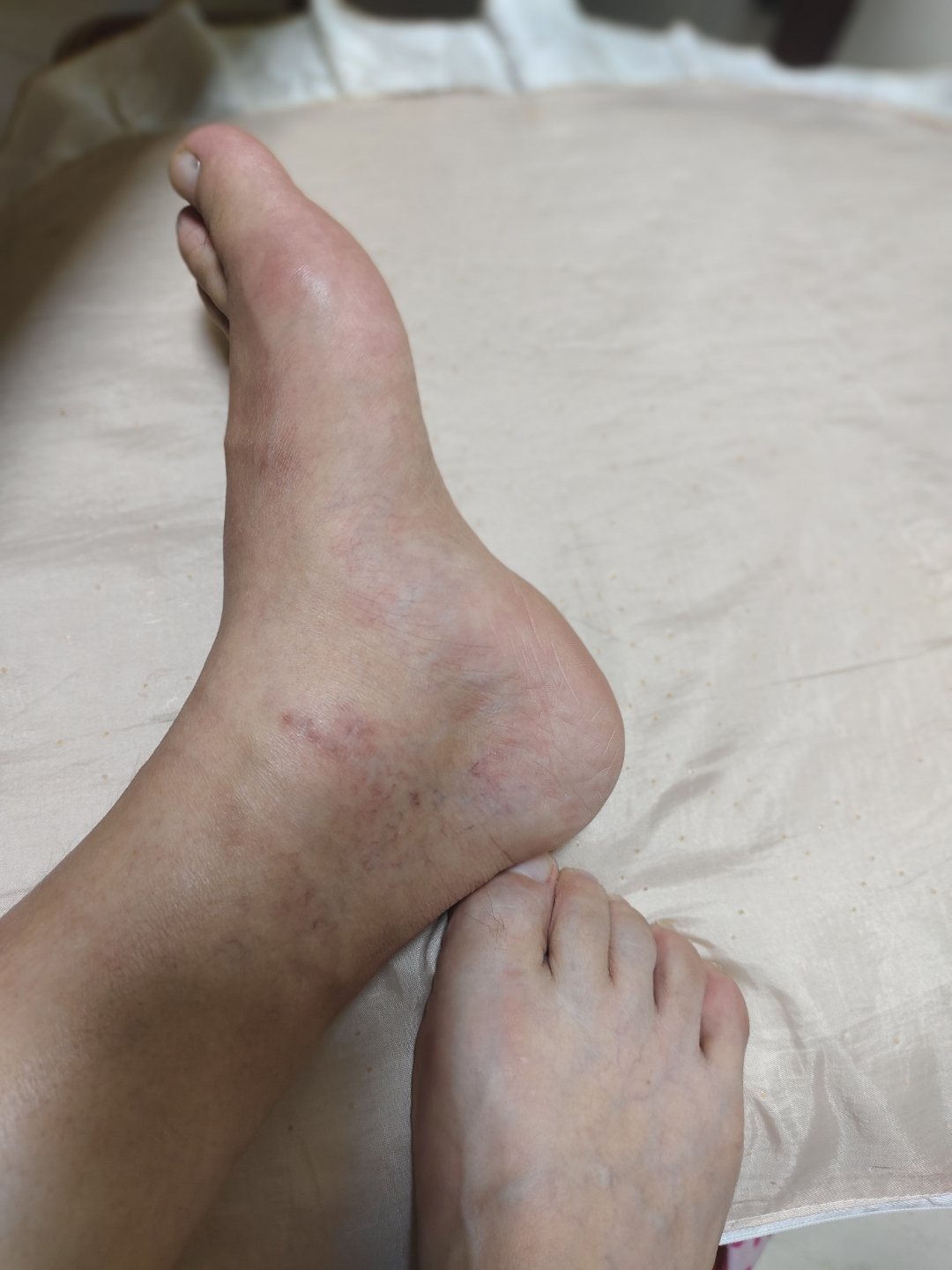 有些肿胀,每天晚上盼着早点上床休息,脚不方便又上班又做家务真心的累