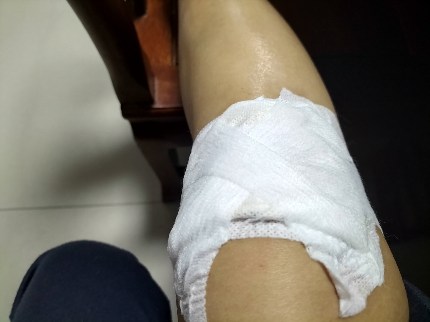 意外受伤,膝盖肿2倍,多处擦伤,敷药2天后已恢复70%