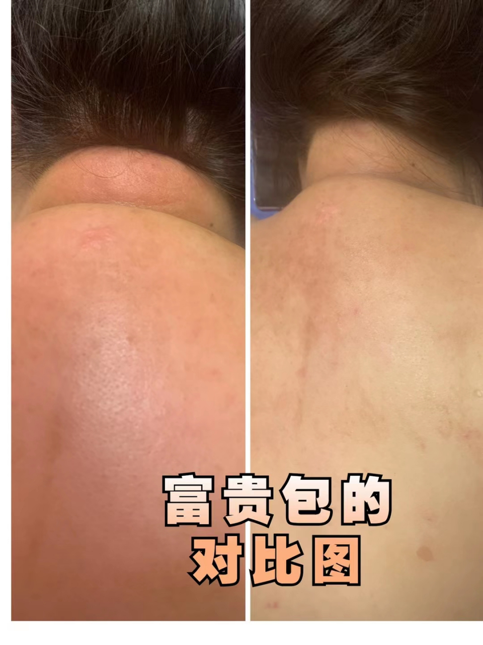 你觉得有富贵包是专属于肥胖人士,还是瘦的人?看出对比图差异有多大吗