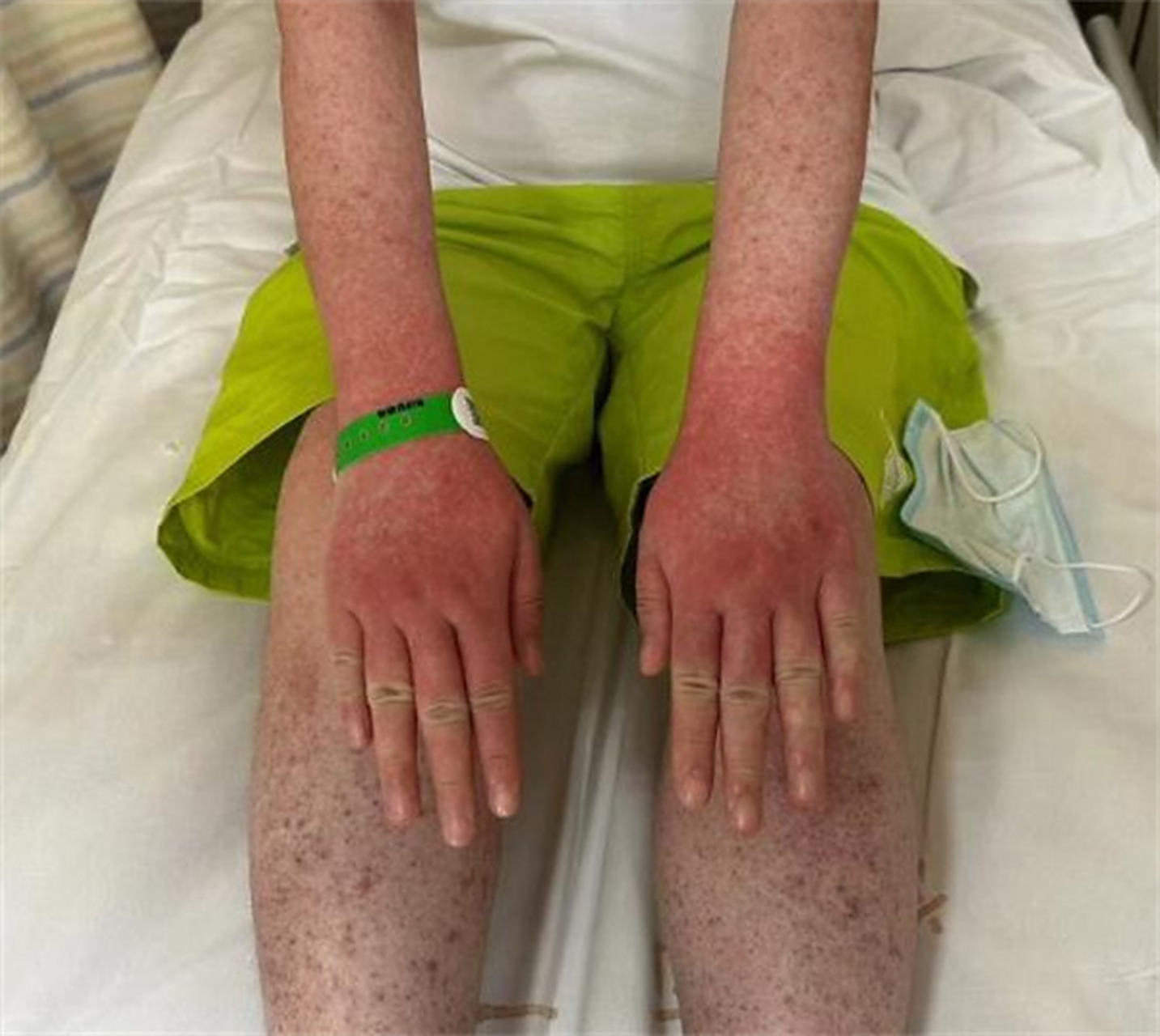 "浙江吴女士到皮肤科就诊,只见她浑身红紫,险些丧命,而这一切的罪魁