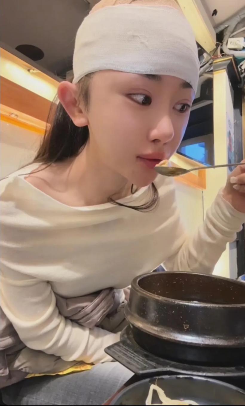 江苏29岁女孩豪掷18万做高颅顶填充手术!