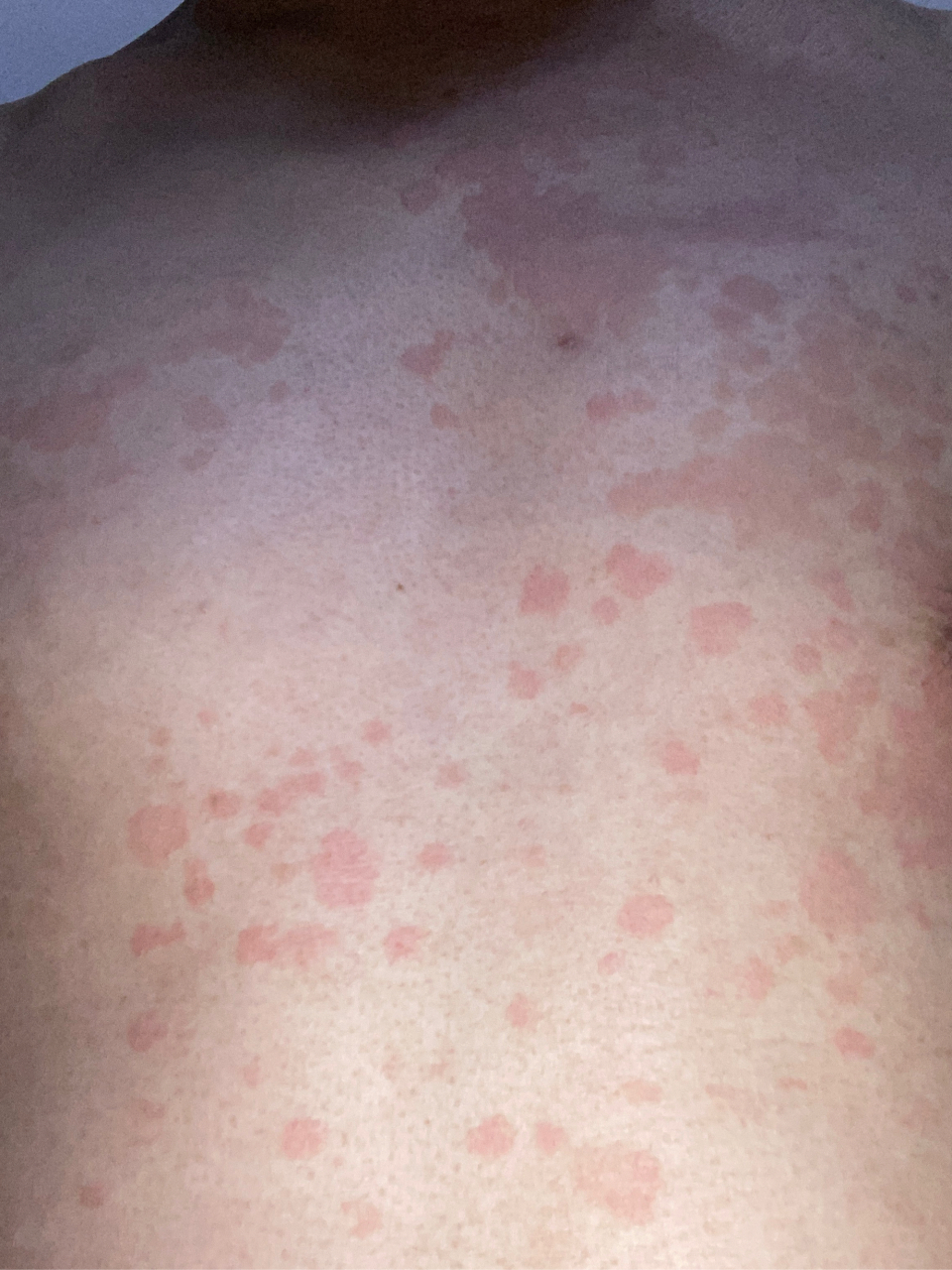 有没有汗斑治疗的好办法或者药物?求大神指教?