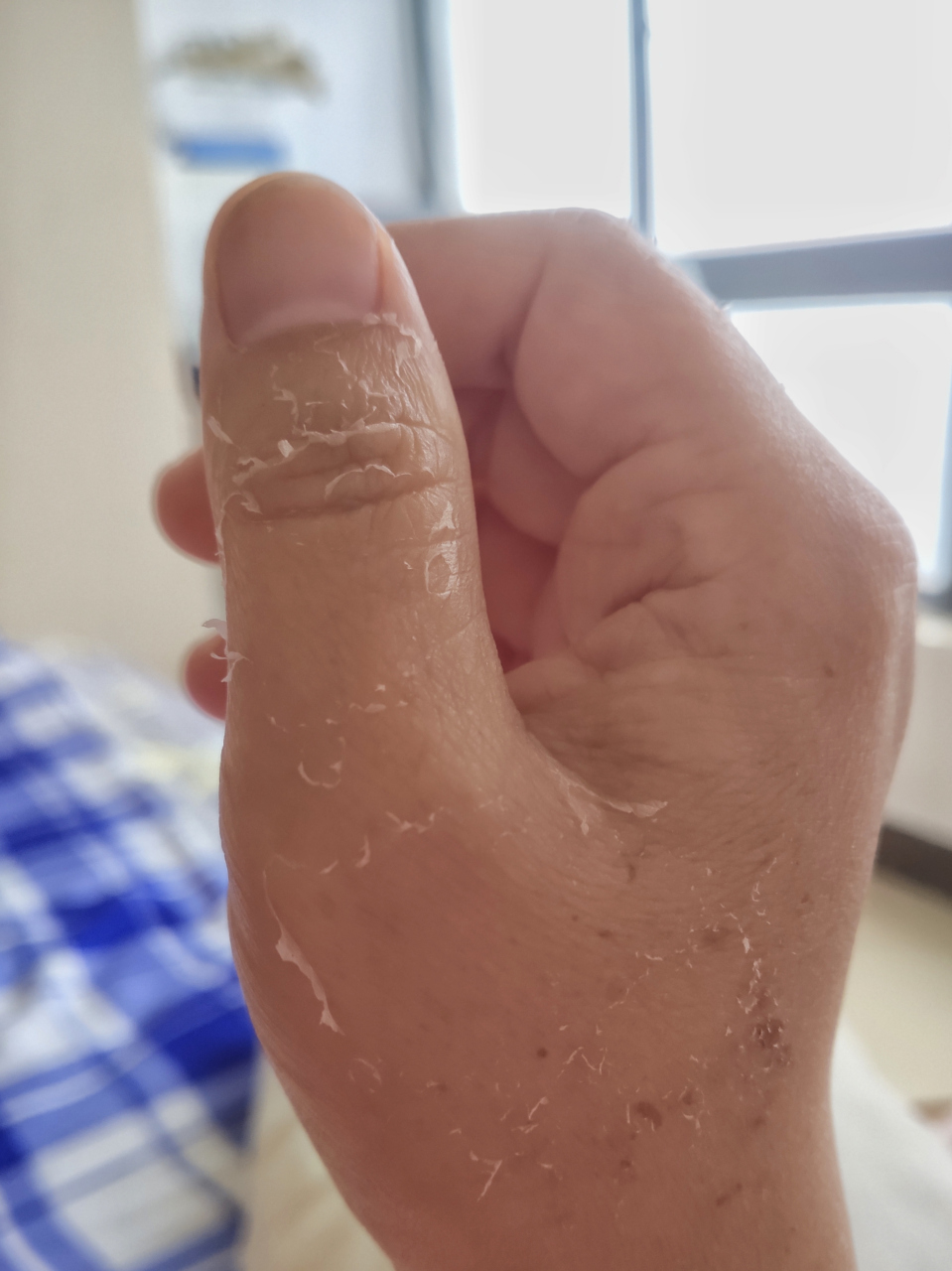 造影剂外渗后续! 胳膊消肿了,也不疼了,水泡溃烂结痂了.